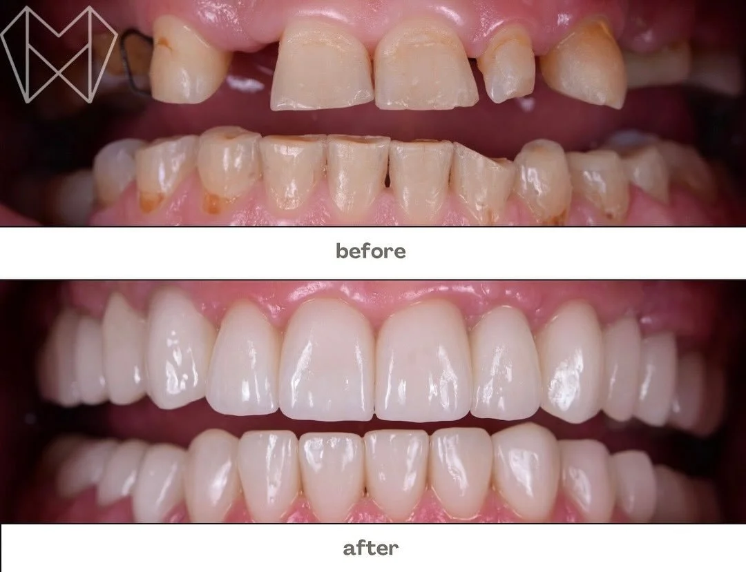A smile transformation that speaks for itself ✨
From worn and missing teeth to a confident, natural-looking smile &mdash; all thanks to our custom dentures! 😁🦷

Ready to love your smile again? 💙
📞 Call us today to book your denture consultation!
