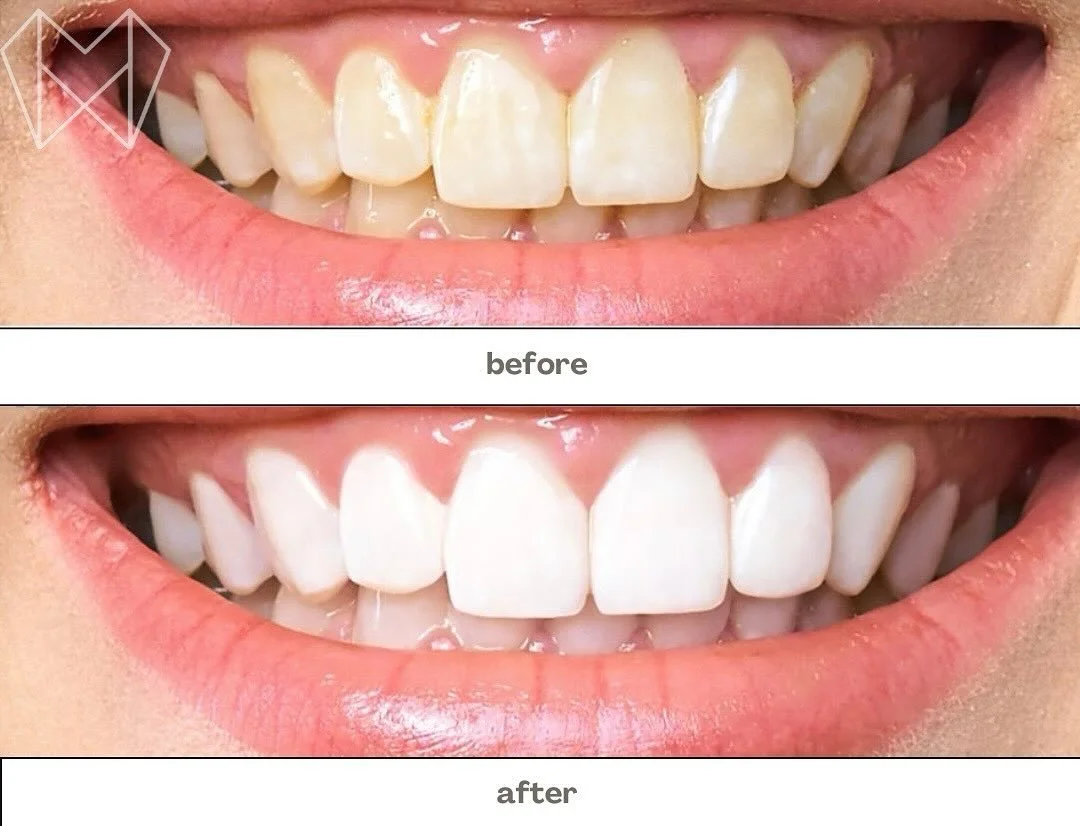 Ready to love your smile again? ✨
We offer professional whitening options to fit your goals and budget from custom take-home trays to in-office treatments for that instant glow! 🌟

Here&rsquo;s a quick breakdown:
💎 Custom Whitening Trays &ndash; $1