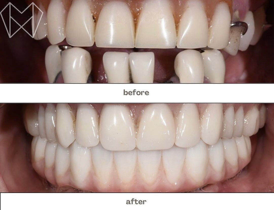 ✨ Implant Supported Dentures ✨

For anyone struggling with loose dentures or missing teeth &mdash; implants can lock your denture in place for more comfort, more confidence + better chewing.

They also help when bone isn&rsquo;t strong enough for sin