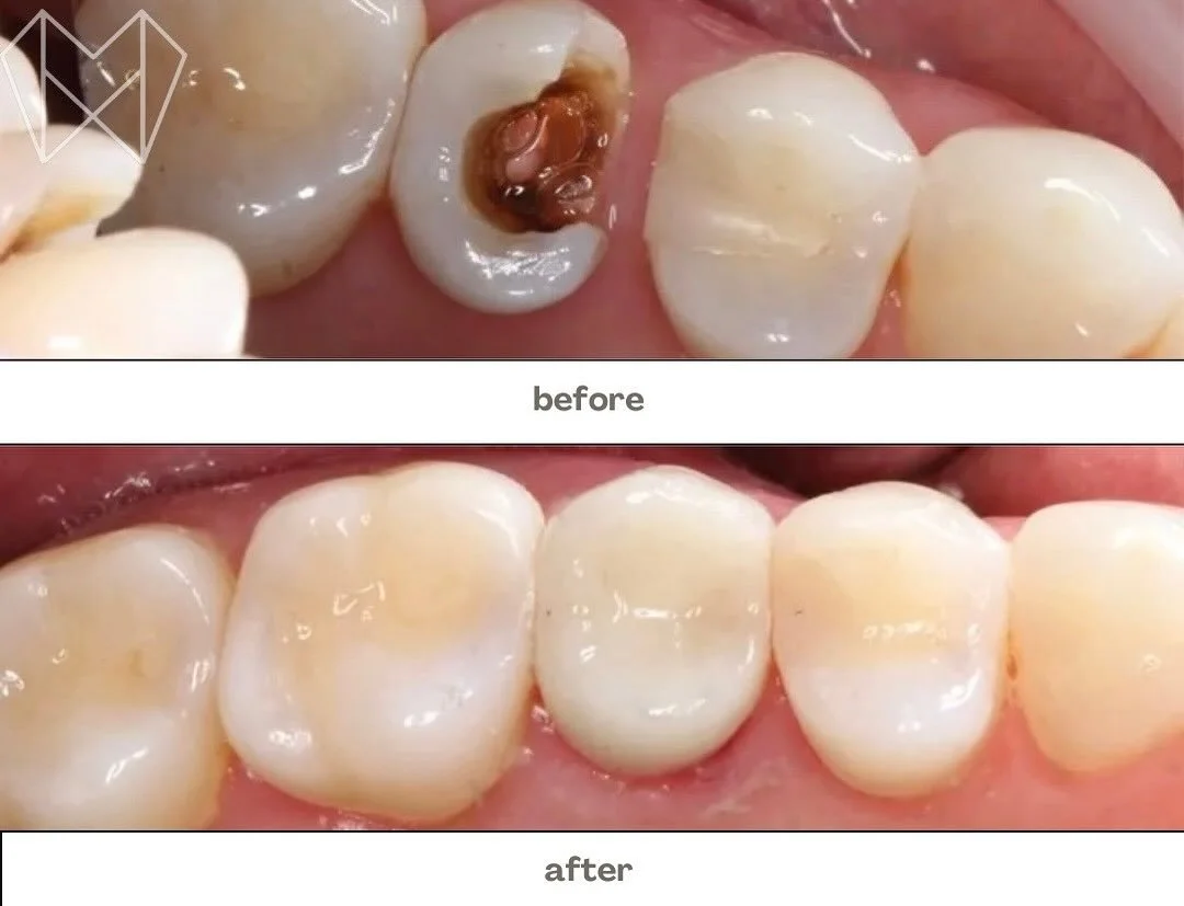 ✨ Before &amp; After: Crown Transformation! 👑
Take a look at how a damaged tooth can come back to life with a beautiful, custom crown!

Crowns are more than cosmetic they protect weakened teeth, prevent further breakage, and help avoid tooth loss do