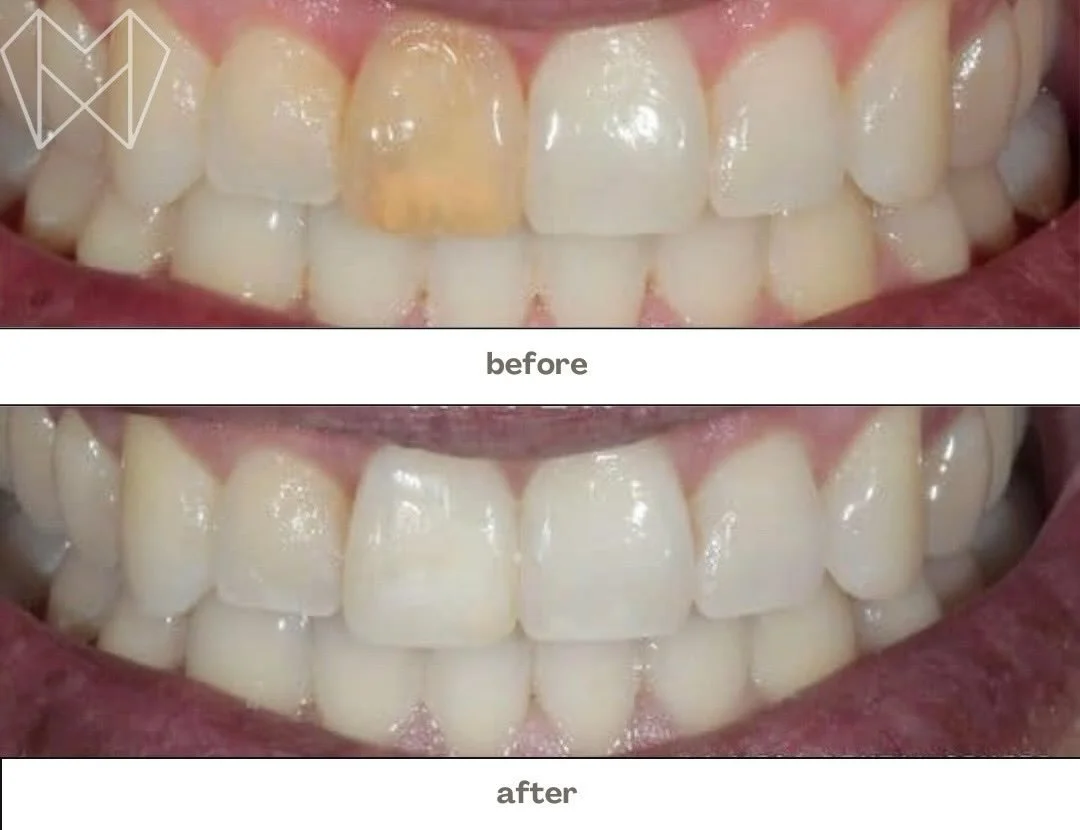 ✨ Does your smile have deep discoloration? ✨
A single dark tooth can happen after a root canal, and internal bleaching may be the perfect way to brighten it from the inside out &mdash; no altering the surrounding teeth needed!

If you&rsquo;ve been h