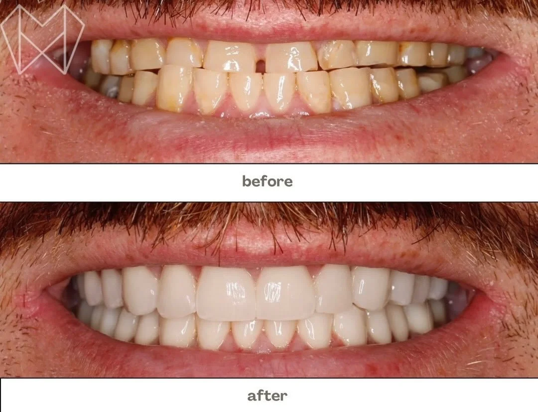 ✨ From worn and discolored to bright, balanced, and confident &mdash; what a transformation!
A healthy, refreshed smile can truly change everything. 😁🦷
Thinking about your own smile upgrade? We&rsquo;re here to help you feel proud of your grin! 💛
