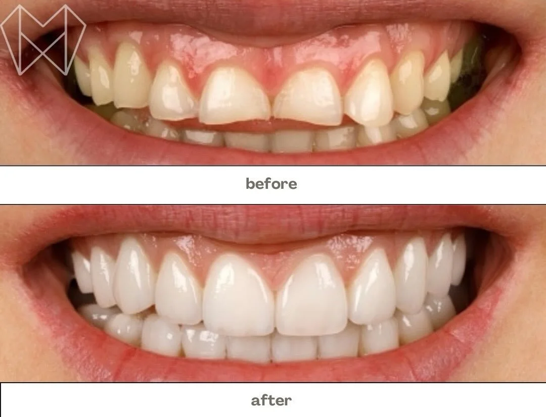From uneven to unreal ✨🦷
A smile makeover that speaks for itself&mdash;brighter, smoother, and beautifully balanced. Proof that small changes can make a BIG confidence boost 😁💫

Thinking about upgrading your smile? We&rsquo;ve got you covered 💙
?
