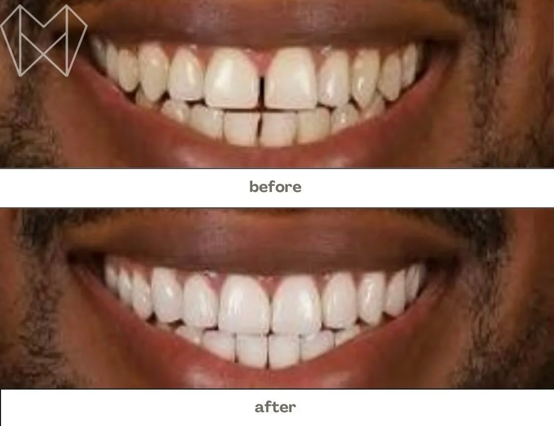 Happy New Year everyone 🎉✨ Welcome 2026 with a confident, healthy smile!

Missing teeth, gaps, or feeling unhappy with your smile? This before &amp; after shows how dental treatment can completely transform both your smile and confidence. 🦷🤍
If yo