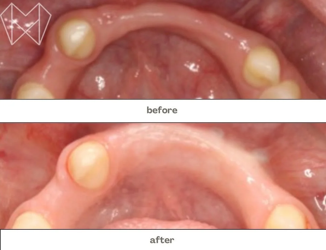 From missing bone to a stronger foundation 🦷✨
Bone graft before ➡️ after &mdash; because a healthy smile starts beneath the surface.

Thinking about implants, dentures, or just want to make sure everything&rsquo;s healing right? A checkup can make a