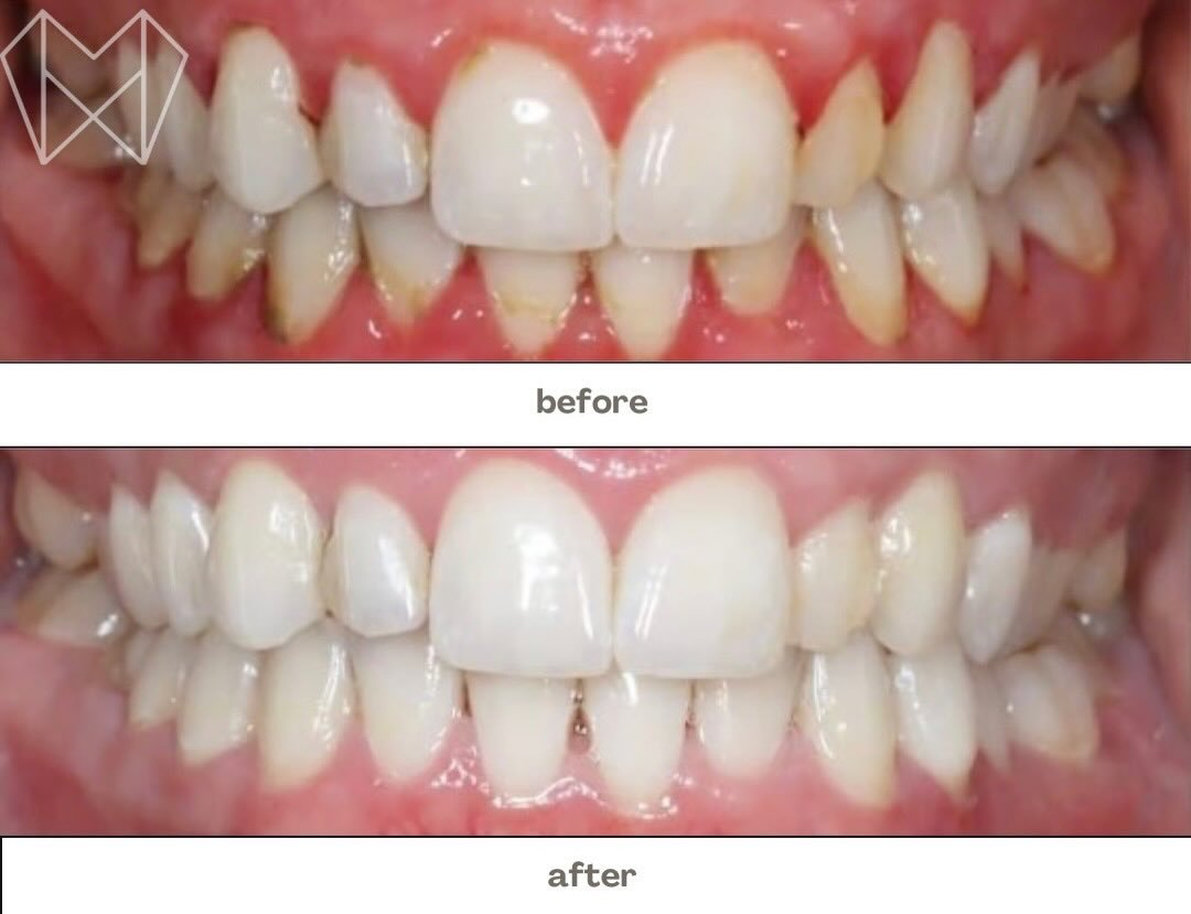 ✨ From buildup to bright in one visit ✨
A professional dental cleaning can make a huge difference &mdash; healthier gums, smoother teeth, and a fresh smile you can feel confident about 😁🦷

📞 Book your appointment today: 519-455-2551

#DentalCleani