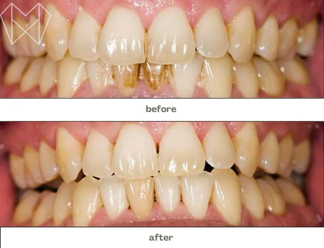 The Power of a Professional Clean! ✨
There is nothing quite like the confidence that comes with a bright, healthy smile. This transformation highlights how we can help remove stubborn staining and buildup to reveal the natural beauty of your teeth.
R