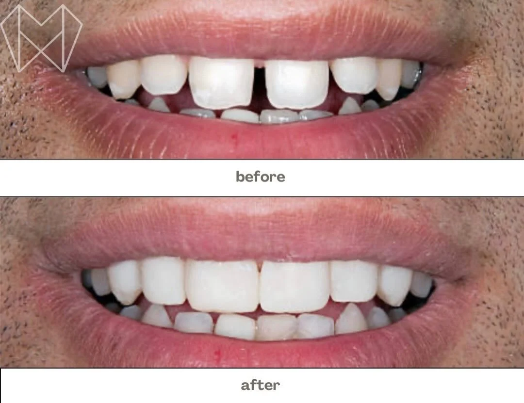 From gaps to glow-up 😏✨
Confidence looks good on you.

Ready for your smile transformation?
📞 Call 519-455-2551 to book today 🦷💫 #SmileMakeover #BeforeAndAfter #DentalConfidence