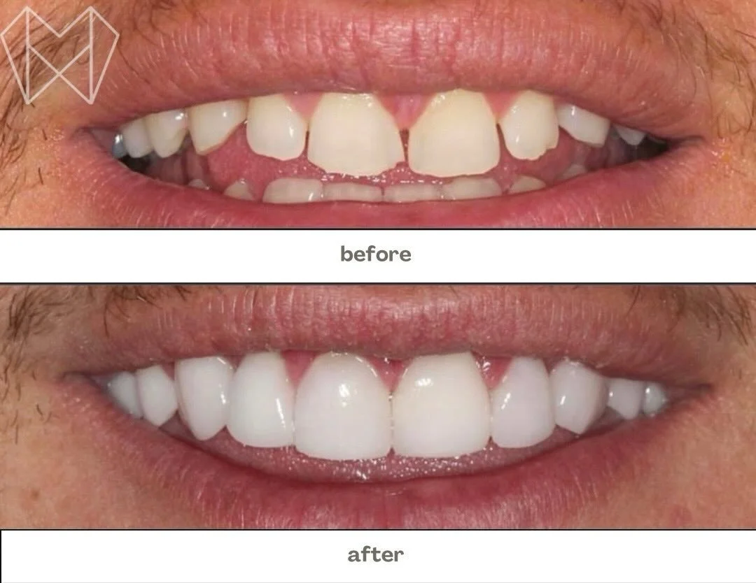 Happy Tuesday! ✨

There&rsquo;s nothing like going through the week with a smile transformation that truly speaks for itself. From chipped and gapped to flawless and confident &mdash; this before &amp; after is proof that your dream smile is closer t