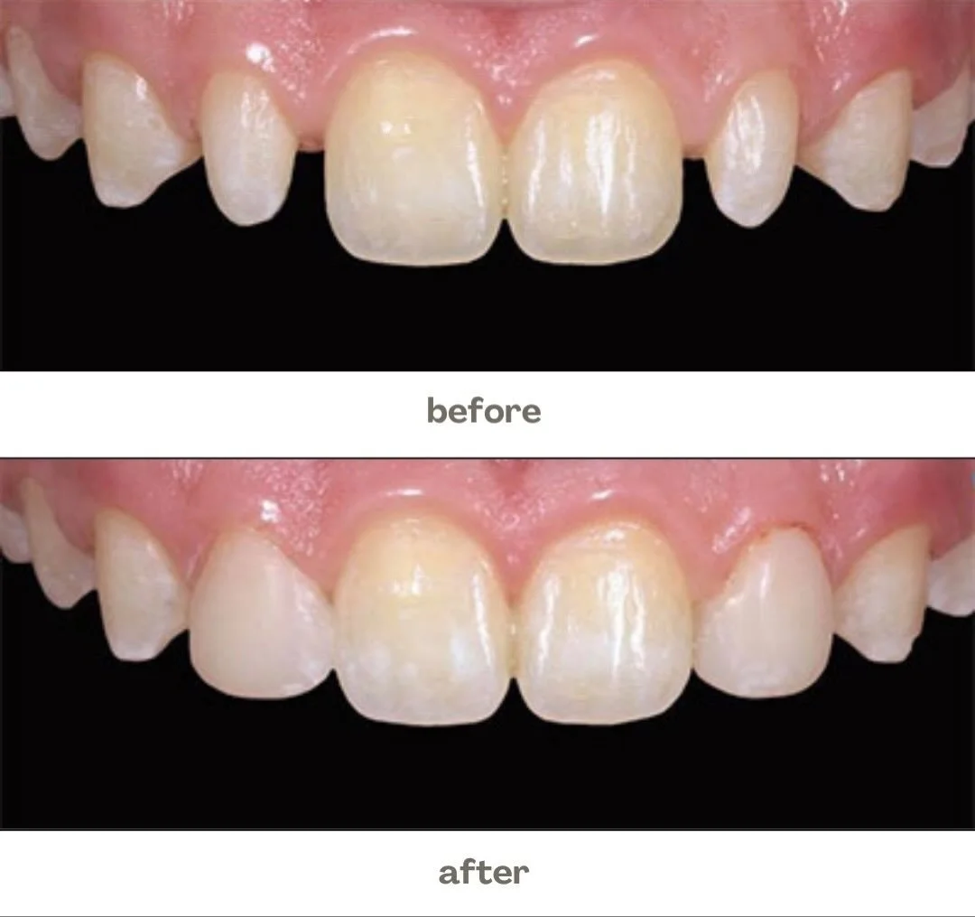 From uneven to effortlessly aligned ✨🦷
Small changes&hellip; BIG confidence boost 😁💫

Because your smile deserves to shine at every angle 💖

#SmileTransformation #BeforeAndAfter #DentalAesthetics #SmileMakeove