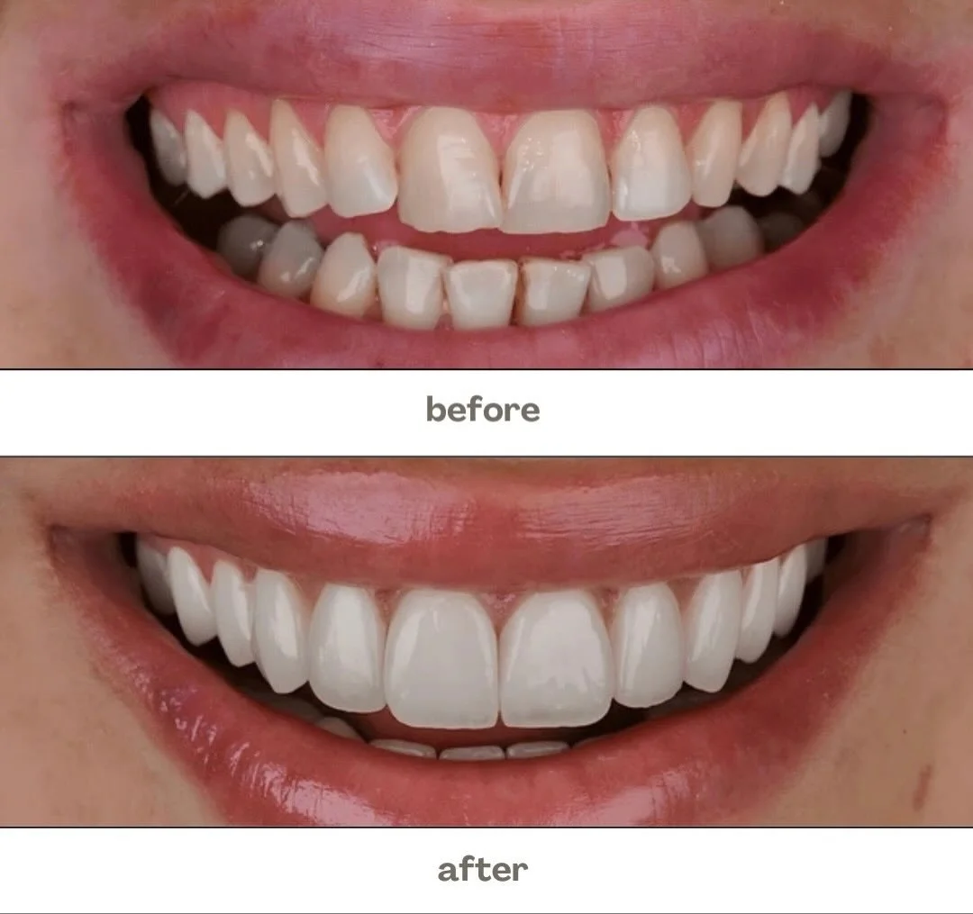 From gaps to gorgeous ✨
A smile transformation that boosted confidence and kept it natural 🤍🦷 #SmileMakeover #BeforeAndAfter #DentalTransformation