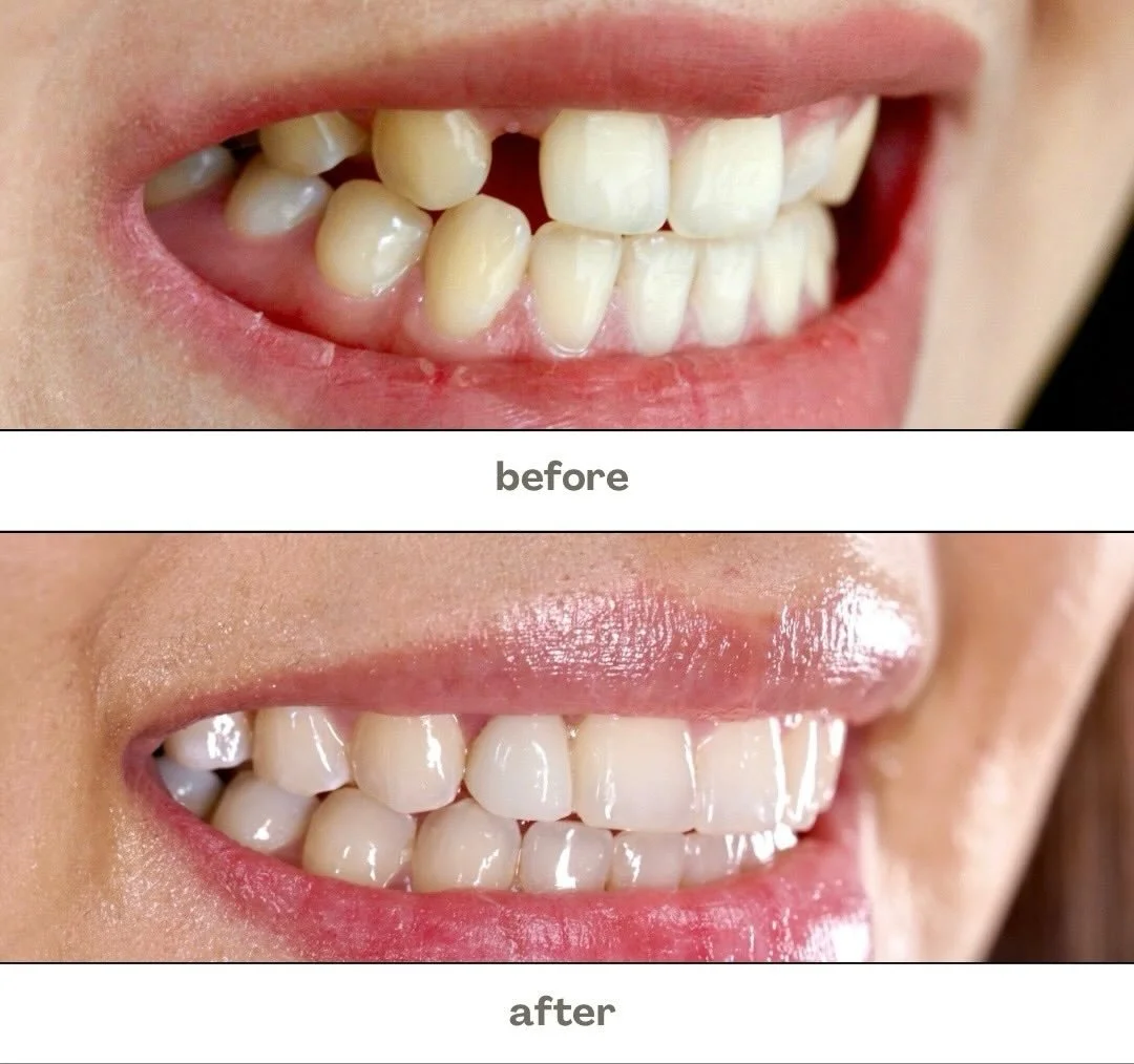 ✨ A confident smile can change everything ✨

From uneven spacing to a beautifully balanced smile 🦷💫
Small changes. Big confidence.

Ready to love your smile again? 🤍
#SmileTransformation #BeforeAndAfter #DentalCare #SmileMakeover #ConfidentSmile