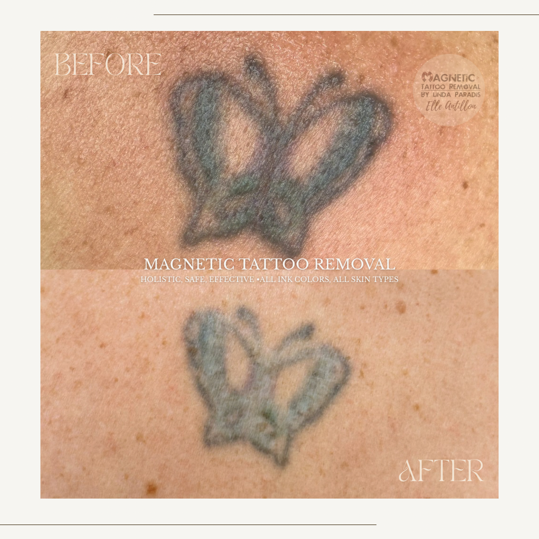 HEALED 2 sessions removal on Body tattoo | 20 year old Multicolor Butterfly pigment comparison.