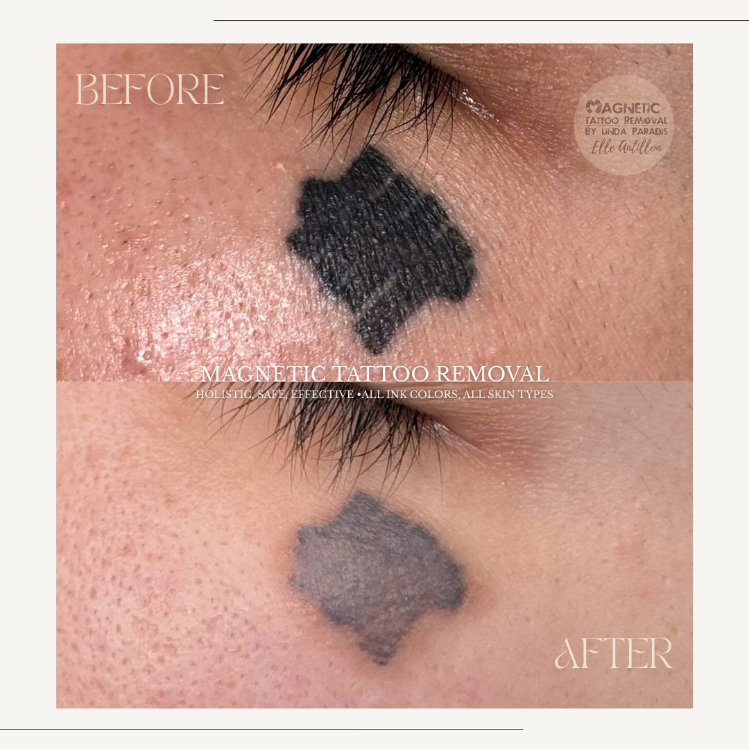 2 weeks Healing desaturating "blown out" Facial tattoo | Black Score lines pigment comparison.