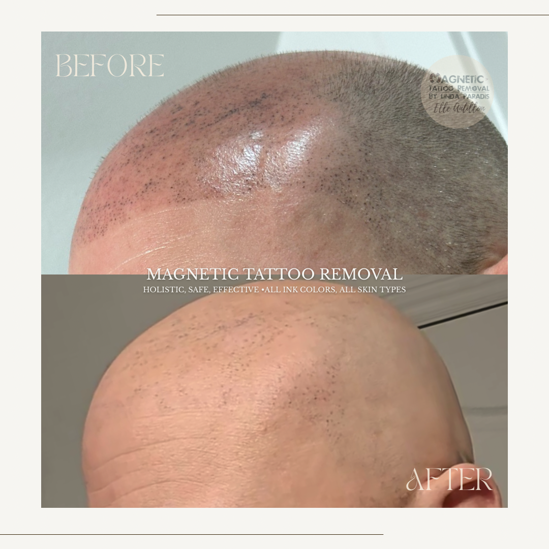 HEALED Scalp micropigmentation Emergency Removal  | Before-and-after comparison of 1 Session