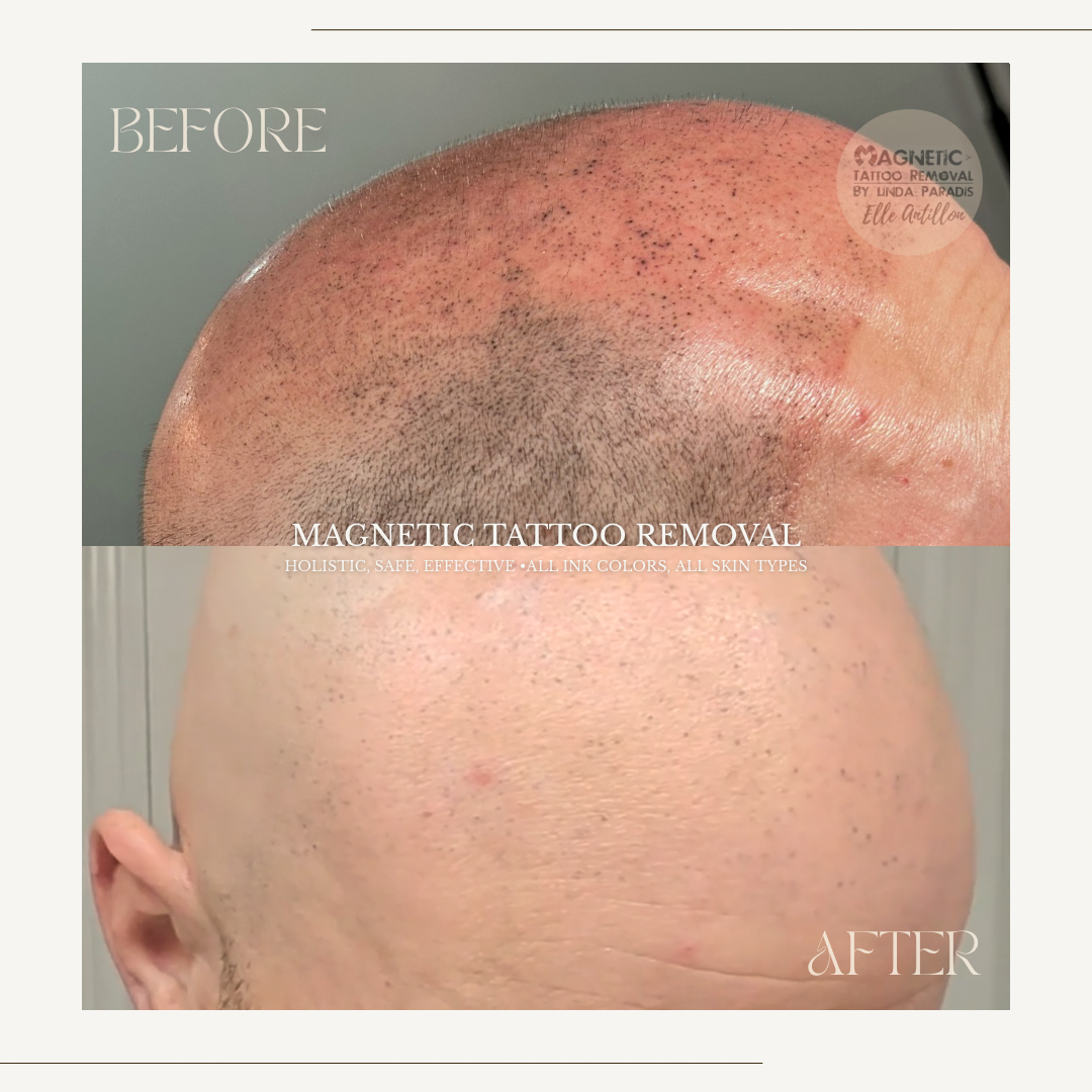 HEALED Scalp micropigmentation Emergency Removal  | Before-and-after comparison of 1 Session