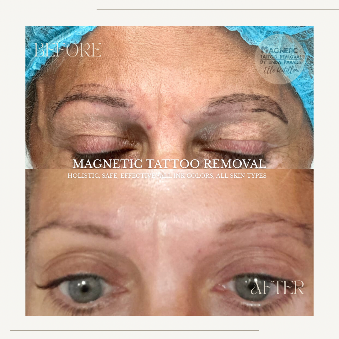 HEALED 2 Sessions removal on Eyebrows with failed permanent makeup | Before-and-after comparison of brow shape and pigment.