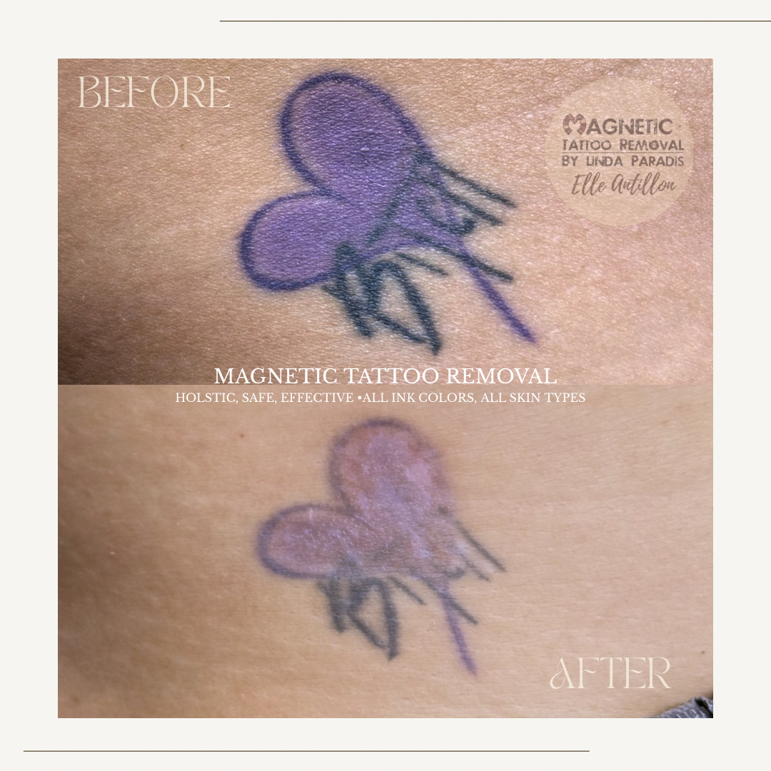 3 Sessions removal IN HEALING 2 weeks post treatment for Body tattoo removal with expletive | Purple butterfly and crude  text pigment comparison.