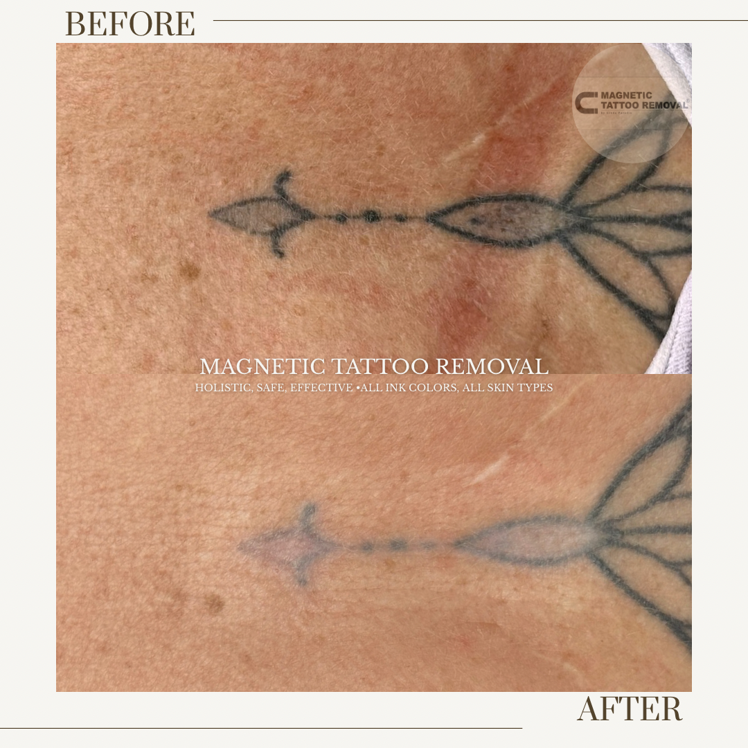 5 Session Healed | Black Line work Chest Tattoo