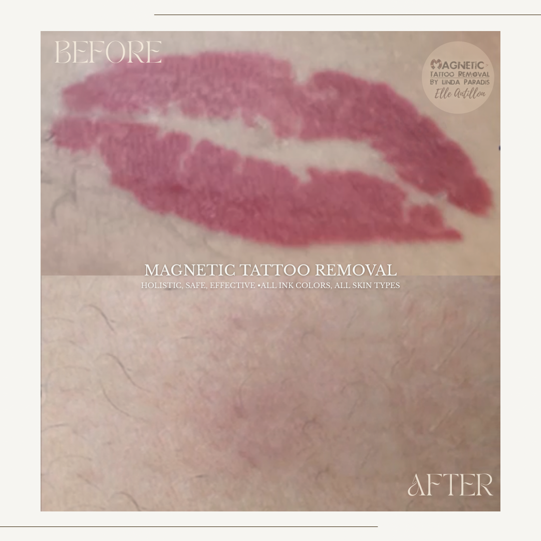 Healed Body tattoo Removal| Red lip-print pigment comparison.