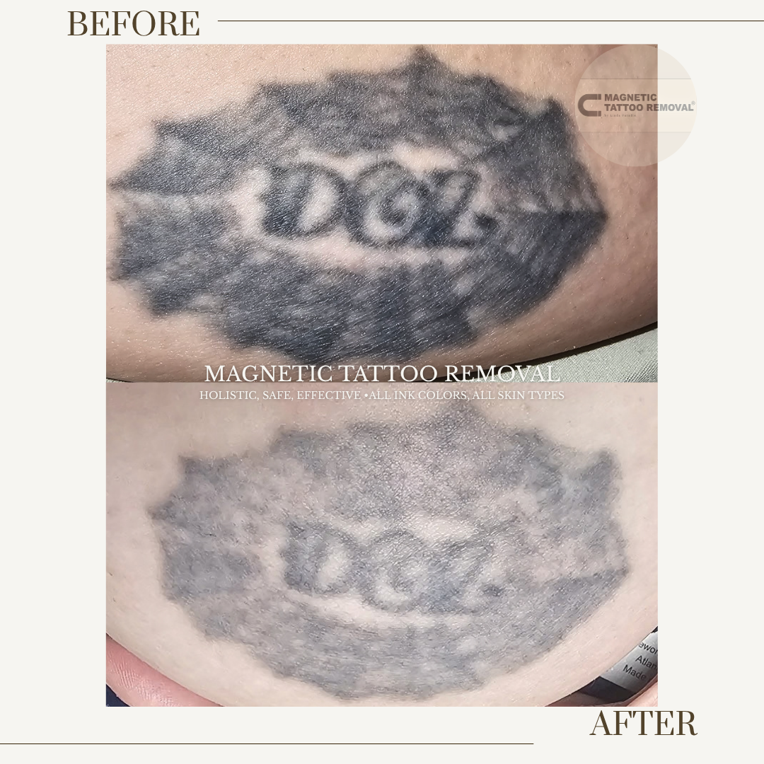HEALED 3 Session | Body Art removal on chest