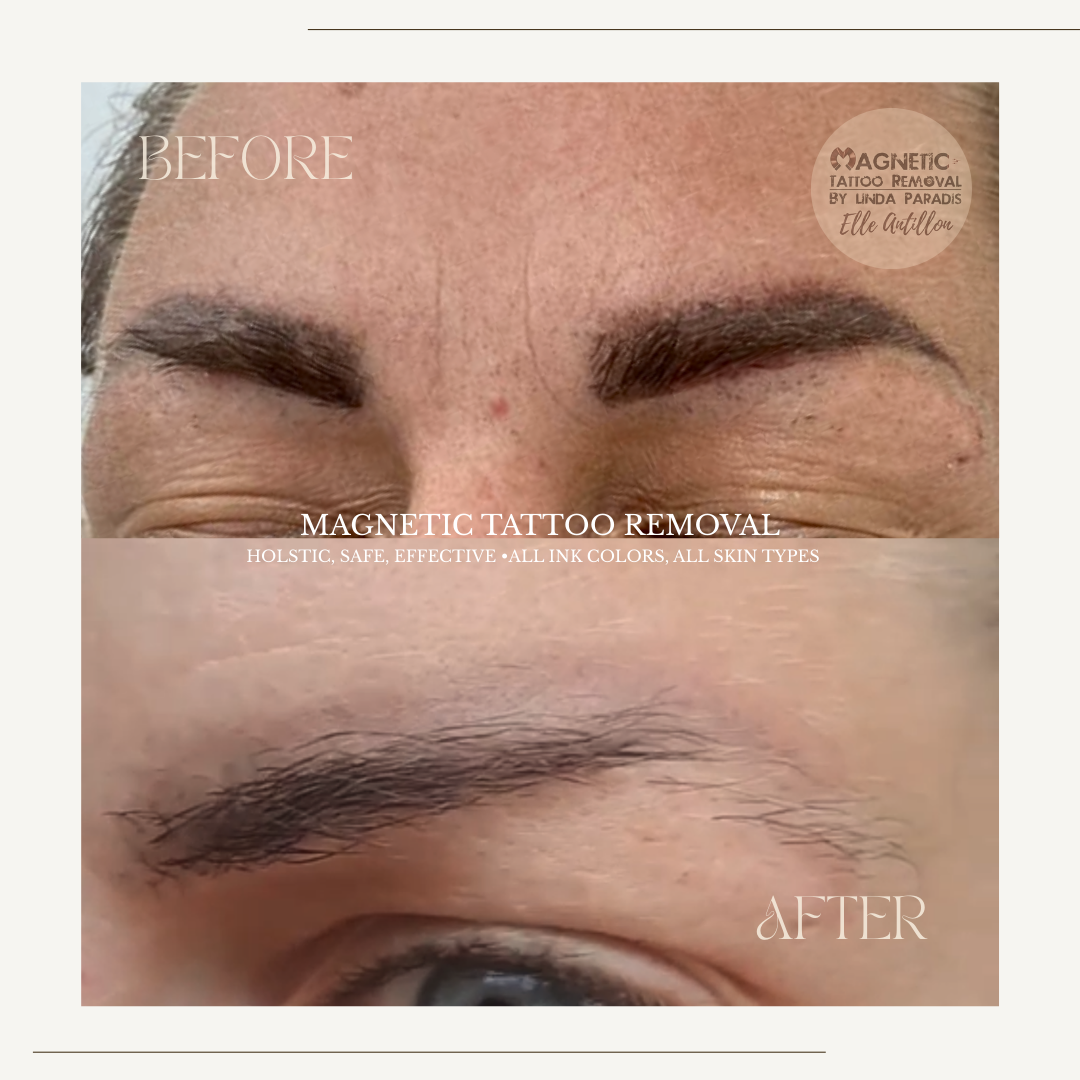 HEALED 3 Sessions Removal on oversized Eyebrow permanent makeup | Before-and-after comparison of brow pigment.