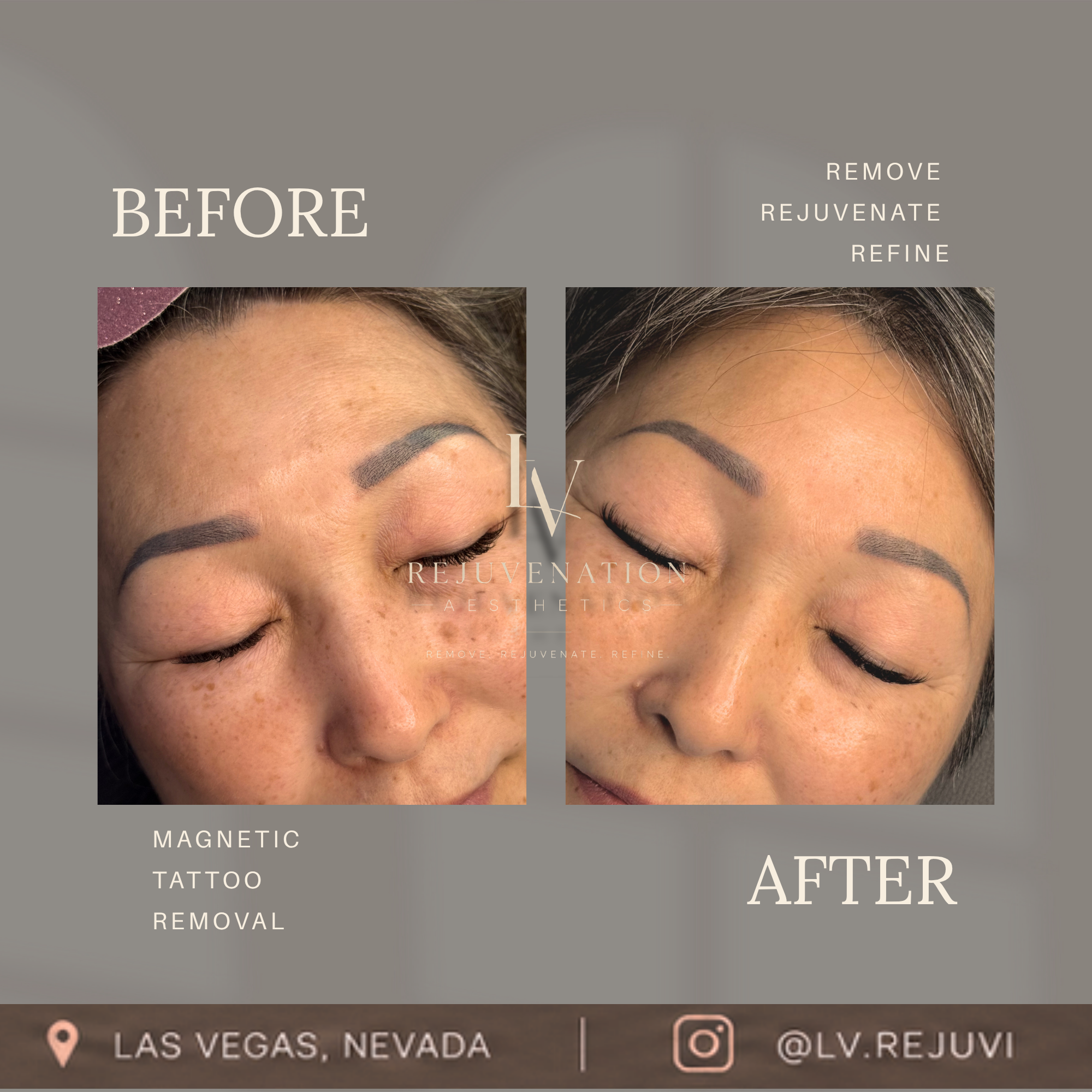 HEALED 3 Sessions | Before-and-after  for even fading of over-saturated pigment