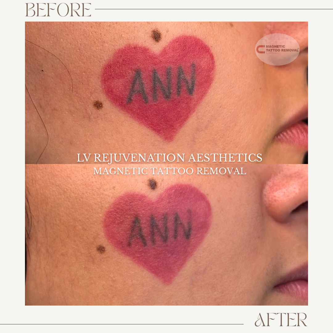 Removal In Progress, HEALED | Red heart and lettering pigment comparison after 2 Sesssions 