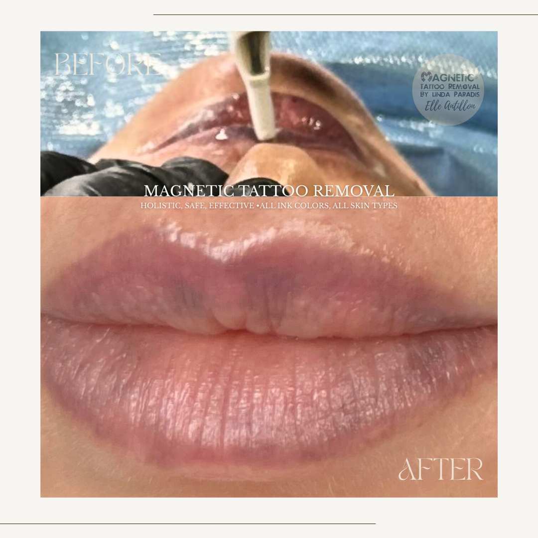 HEALED Removal for Failed Lip Blush | Before-and-after comparison of 3 Sessions 