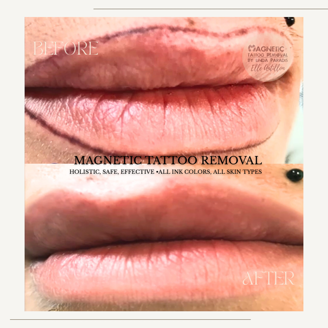 HEALED Over-lined  permanent Lip liner  | Before-and-after comparison of 4 Sessions.