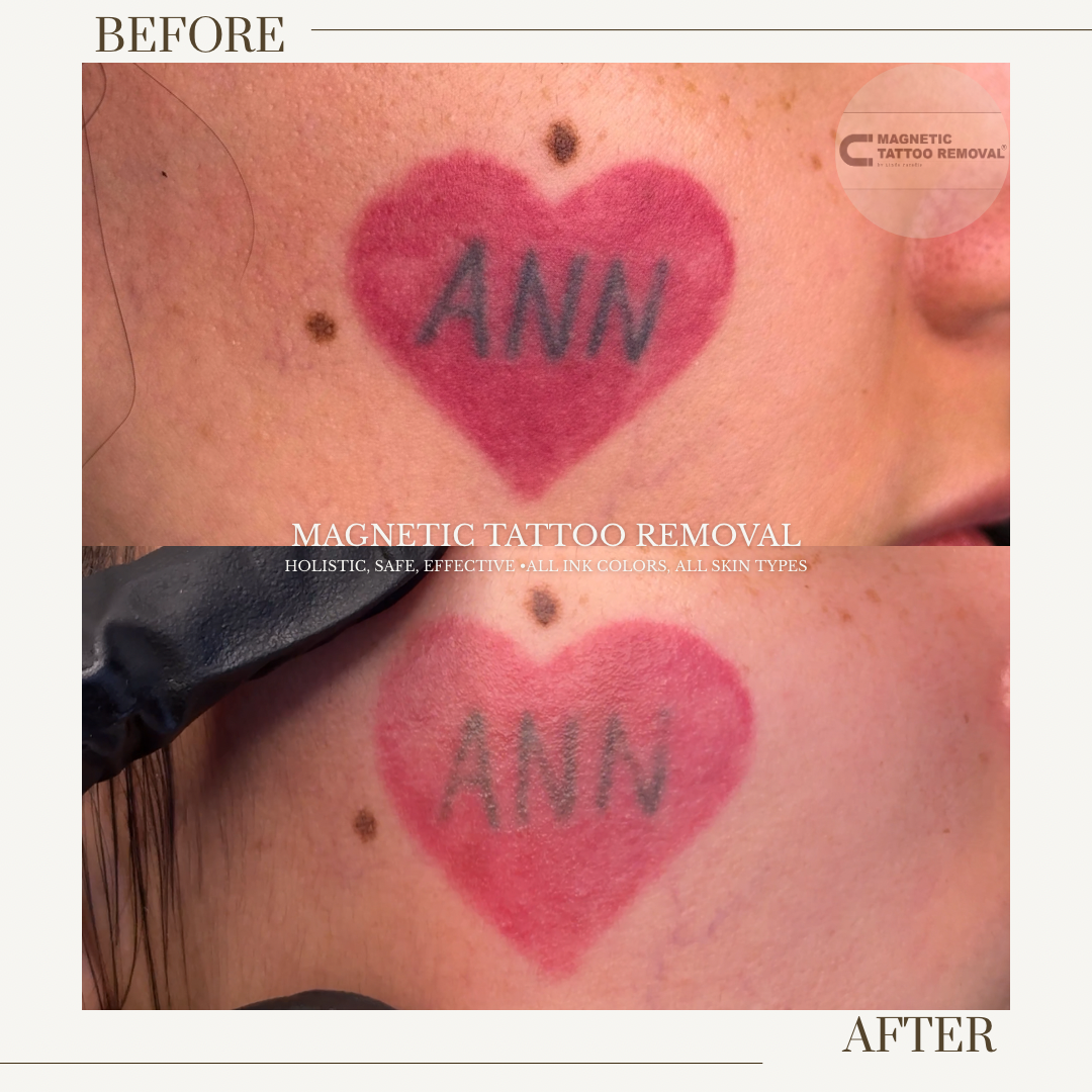 Removal In Progress, HEALED 3 Sessions | Red heart and lettering pigment tattooed with Body Art Ink