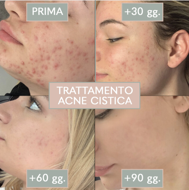 Acne cistica. Non ti temo!
