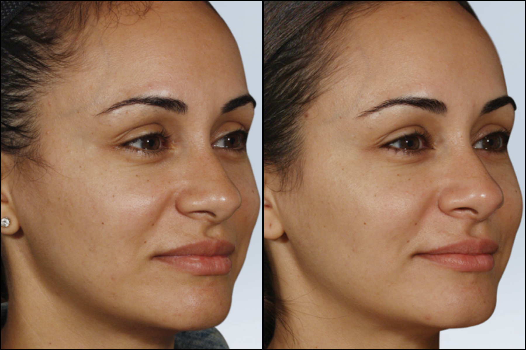 sculptra B&A.png