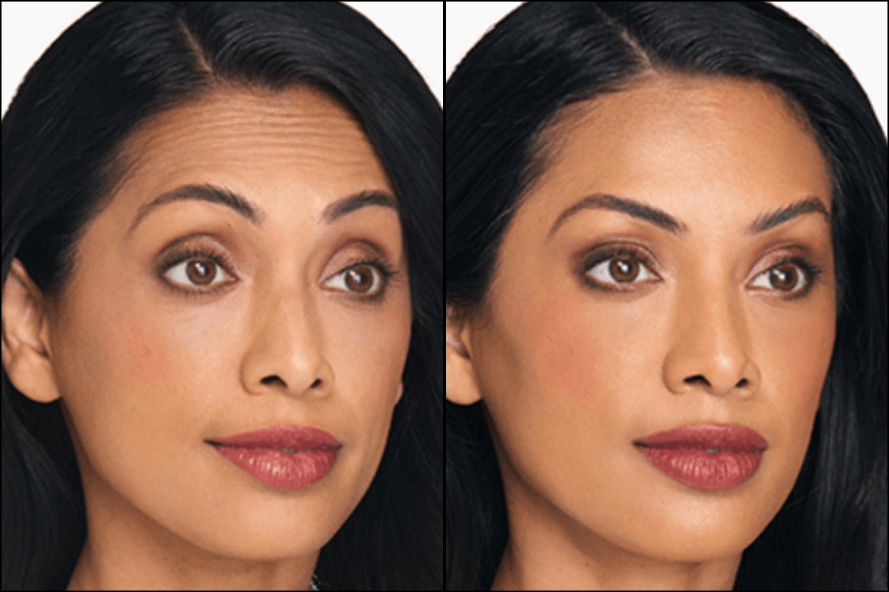 tox forehead B&A.png