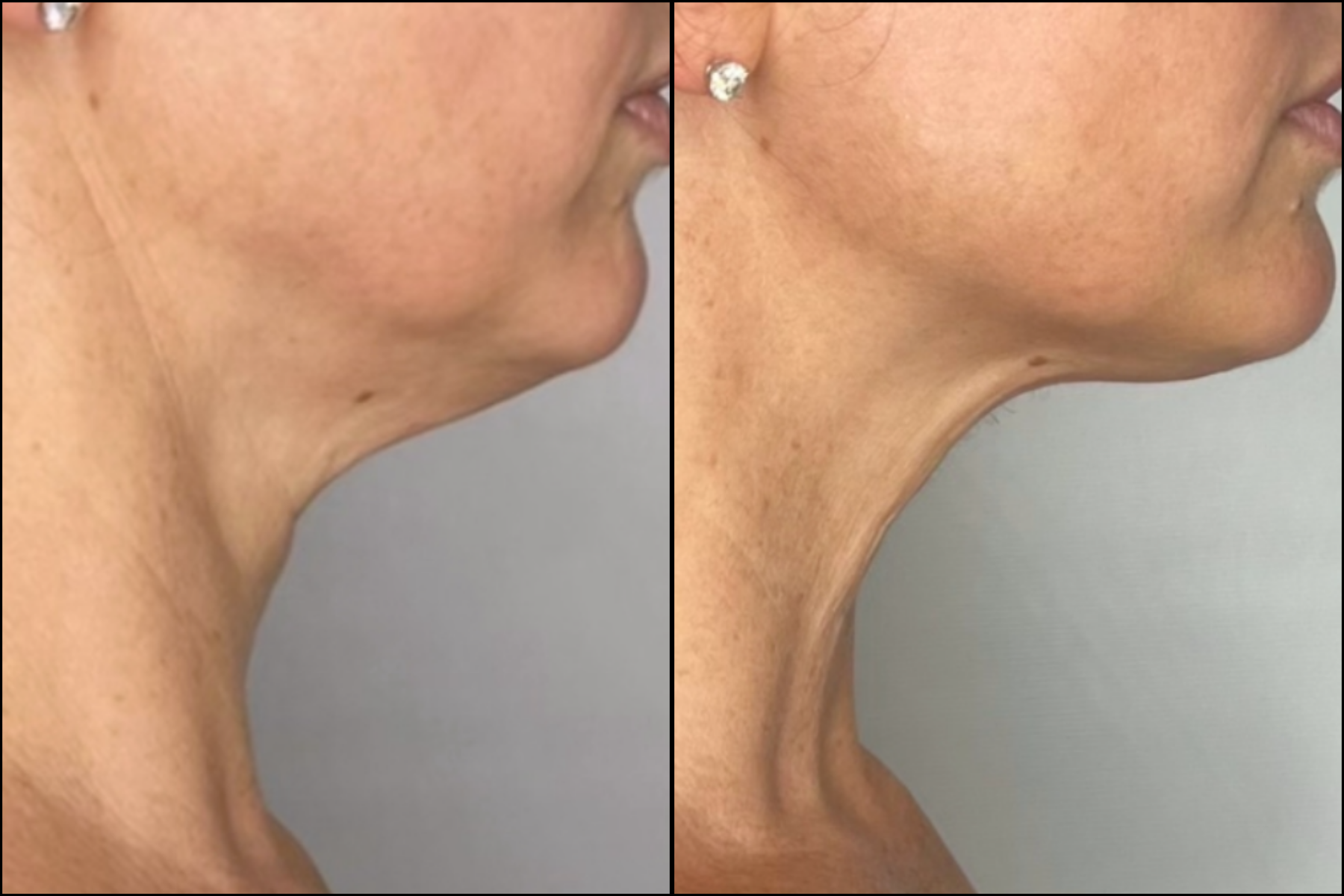 sofwave neck B&A.png