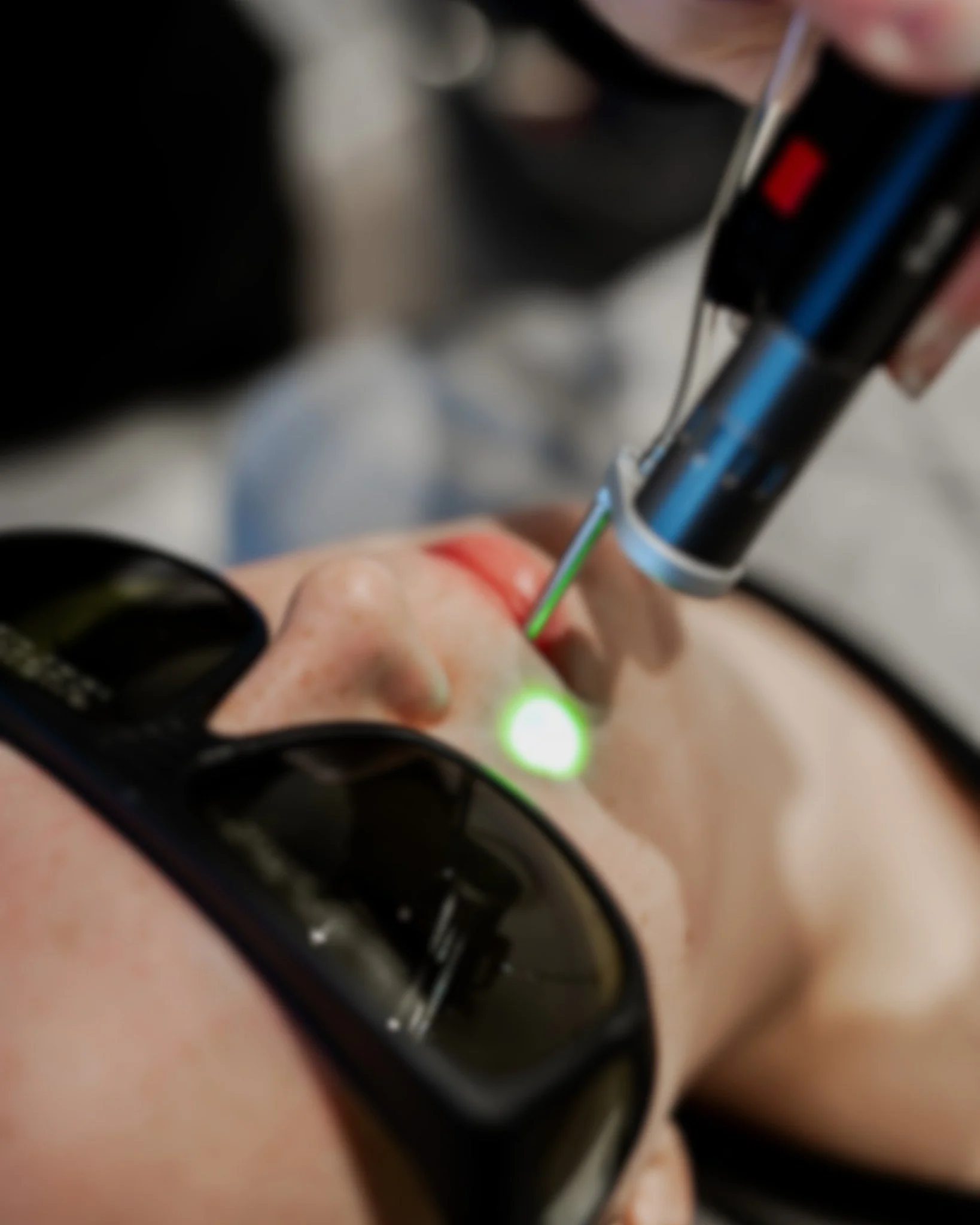 Say Goodbye to Unwanted Hair with Laser Hair Reduction! ⚡
Tired of constant shaving, waxing, or dealing with ingrown hairs? Laser hair reduction offers a safe, long-term solution for both men and women, treating unwanted hair on the face and body wi