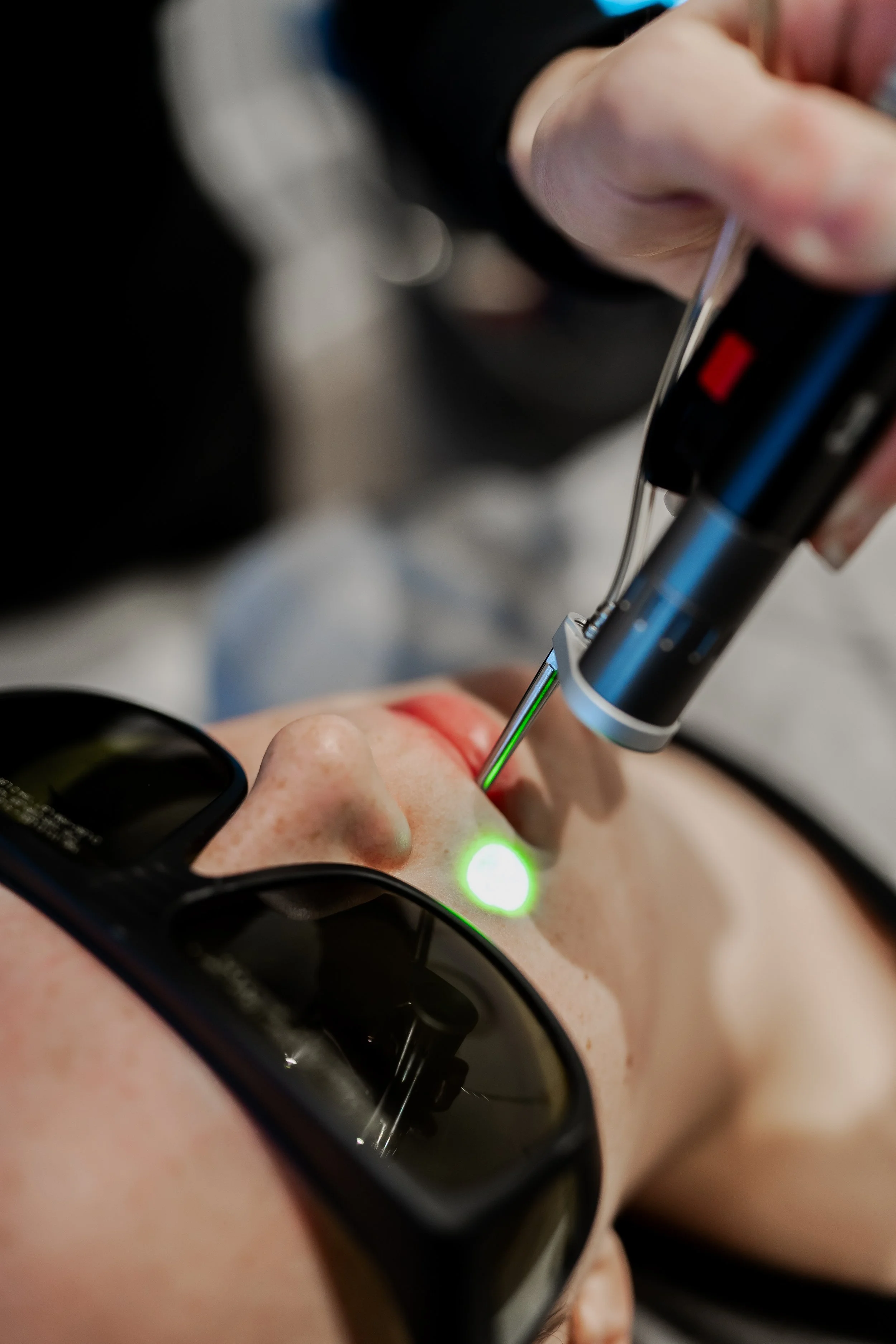 Person receiving laser facial treatment, wearing protective eyewear.