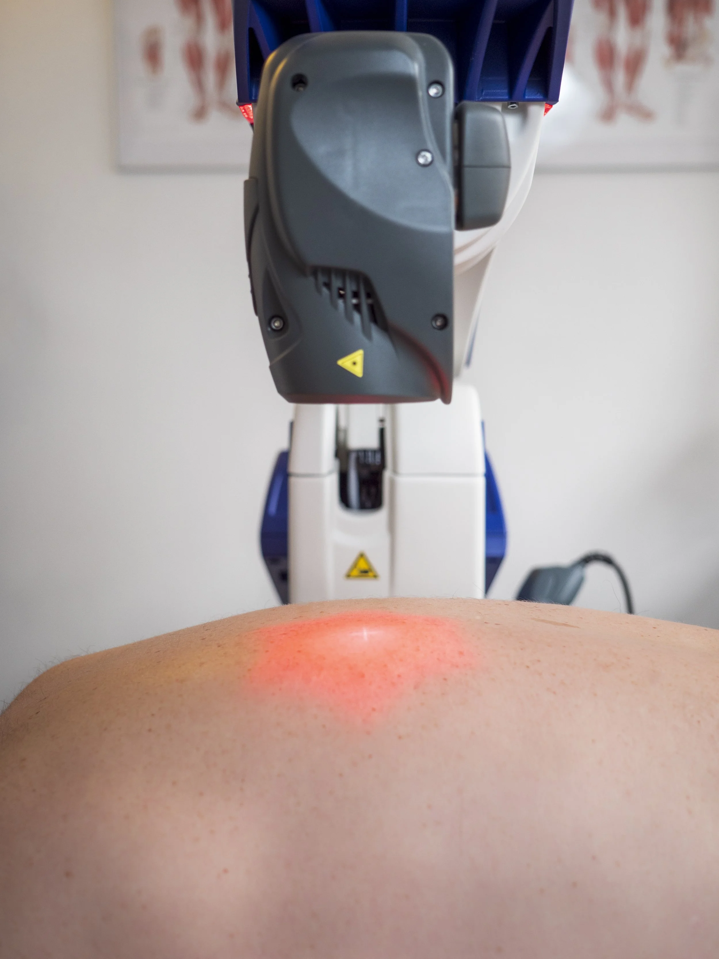 ASAlaser laserudstyr anvendt til laserbehandling på hud med synligt rødt laserlys. Billedet illustrerer finansiering af professionelt udstyr til klinikker, der ønsker at tilbyde MLS-laserterapi og laserbehandling.