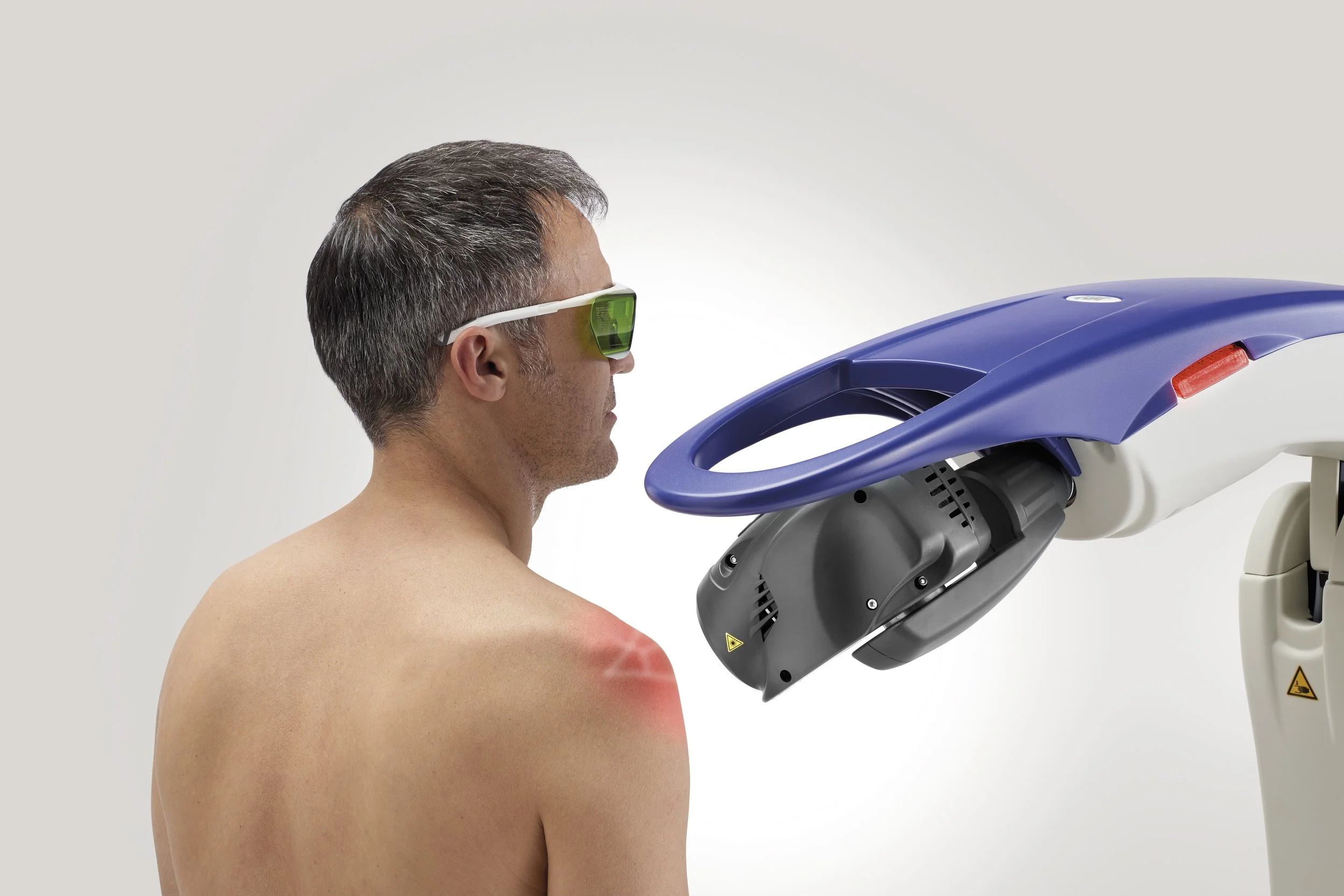 ASA Laser M6 laserterapi udstyr behandler skulderled og skulder med laser