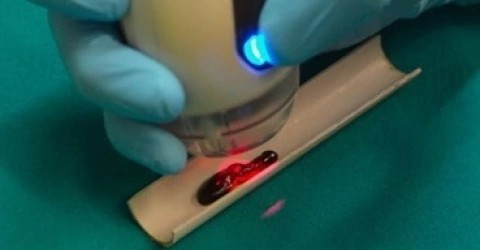 Kompleks sårheling med 3D bioprinting og laserterapi fra ASAlaser