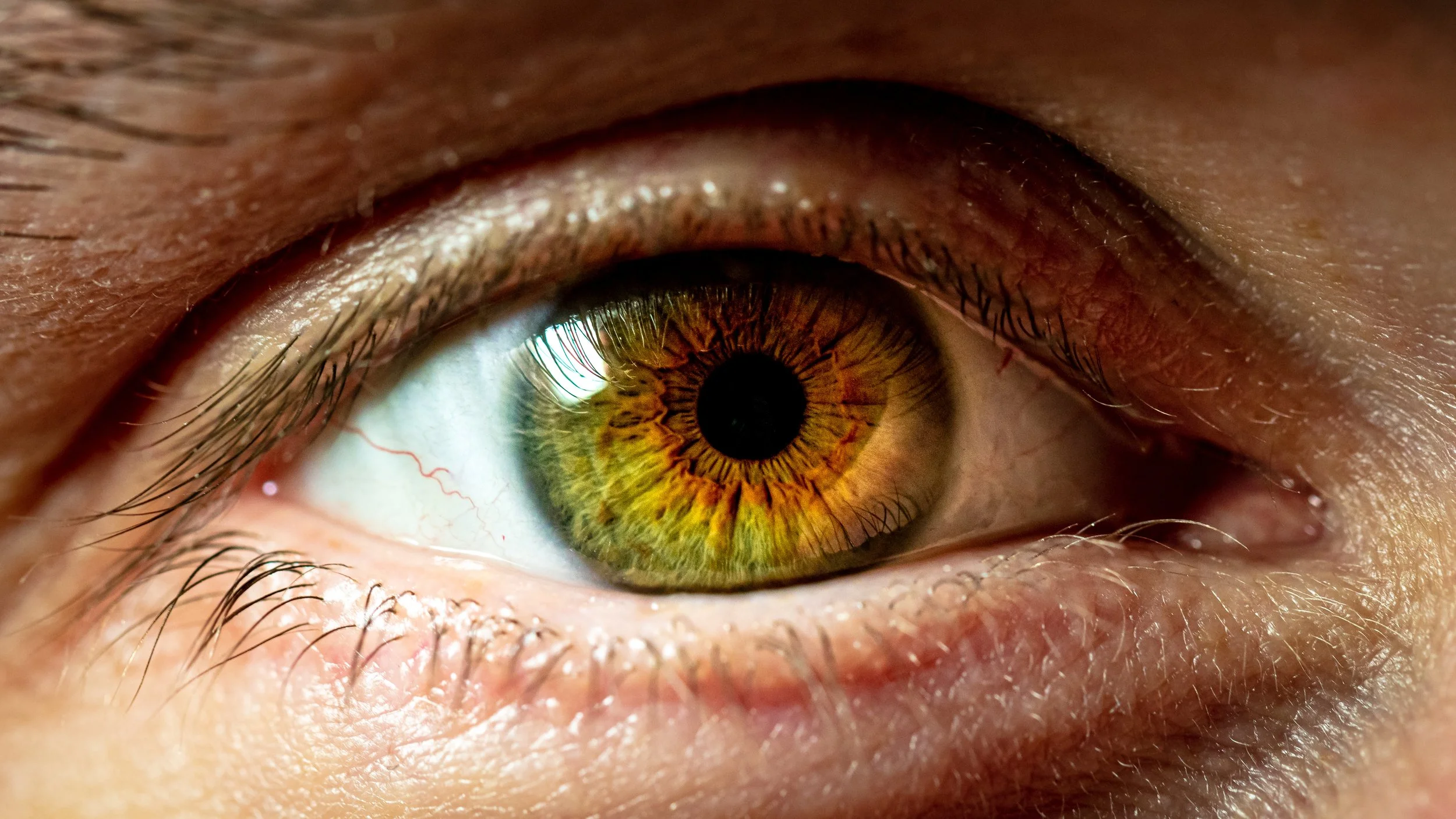 Meibomian Gland Dysfunction: Why Your Eyes Might Be Dry