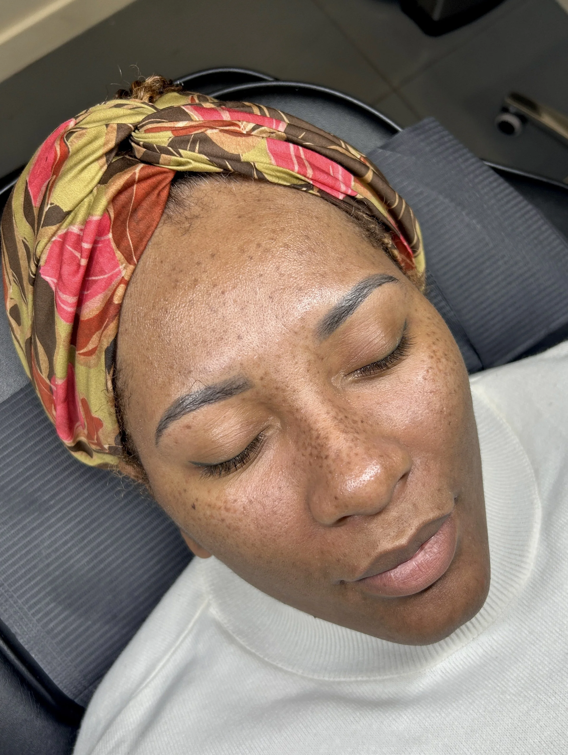 Bold healed freckles by iona wallace in Las Vegas, Nevada., Las Vegas.