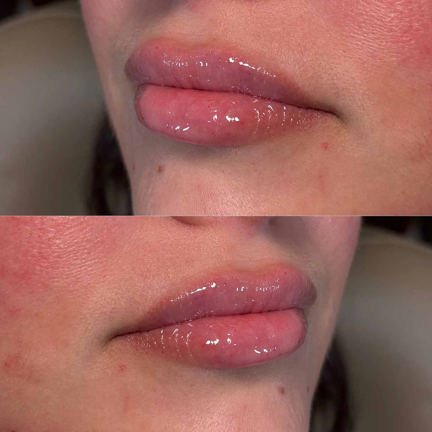 The perfect lift does exist. It just doesn&rsquo;t look &lsquo;done.&rsquo;&rdquo;

At Oriya, we focus on subtle elevation to restore contour, support structure, and enhance your natural beauty &mdash; never change your face.

Results that look effor