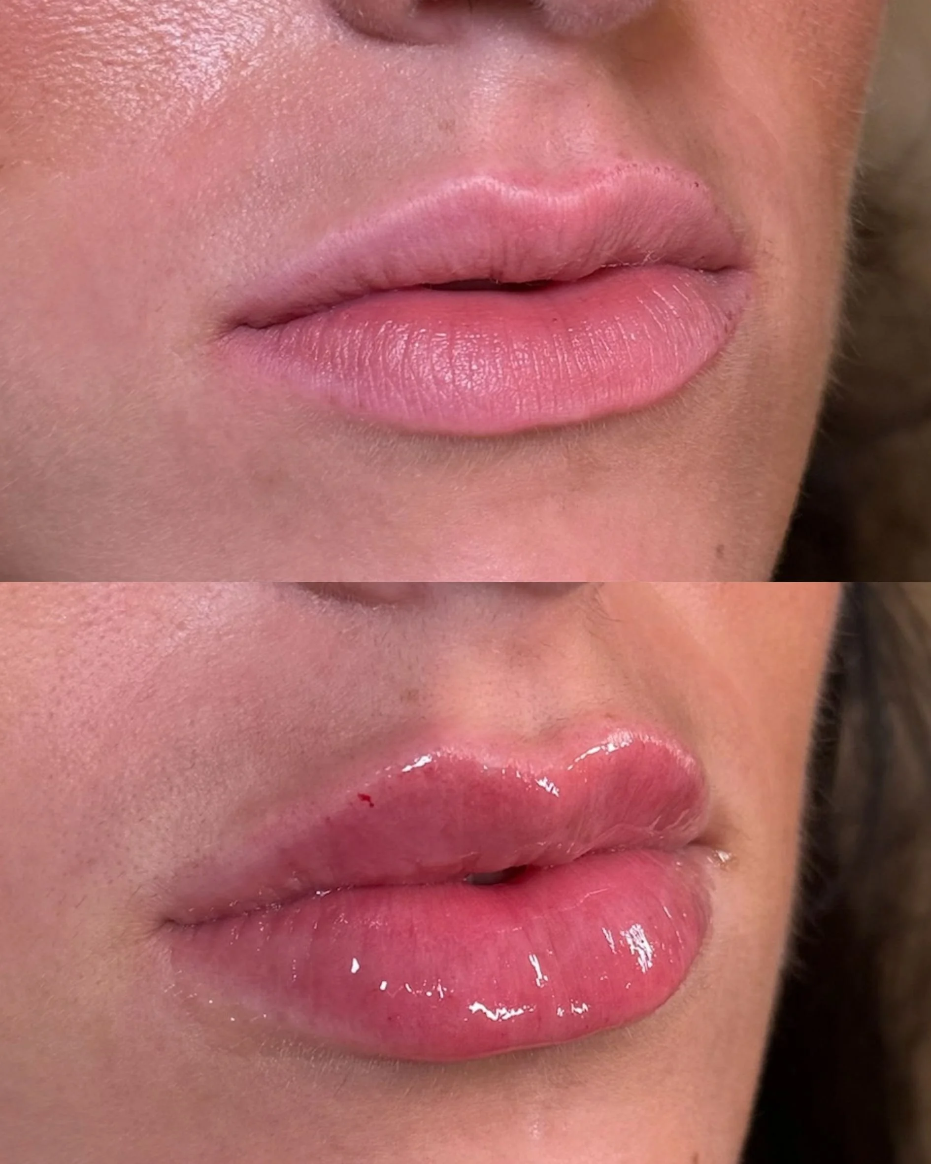 LIP FILLER (5).jpg
