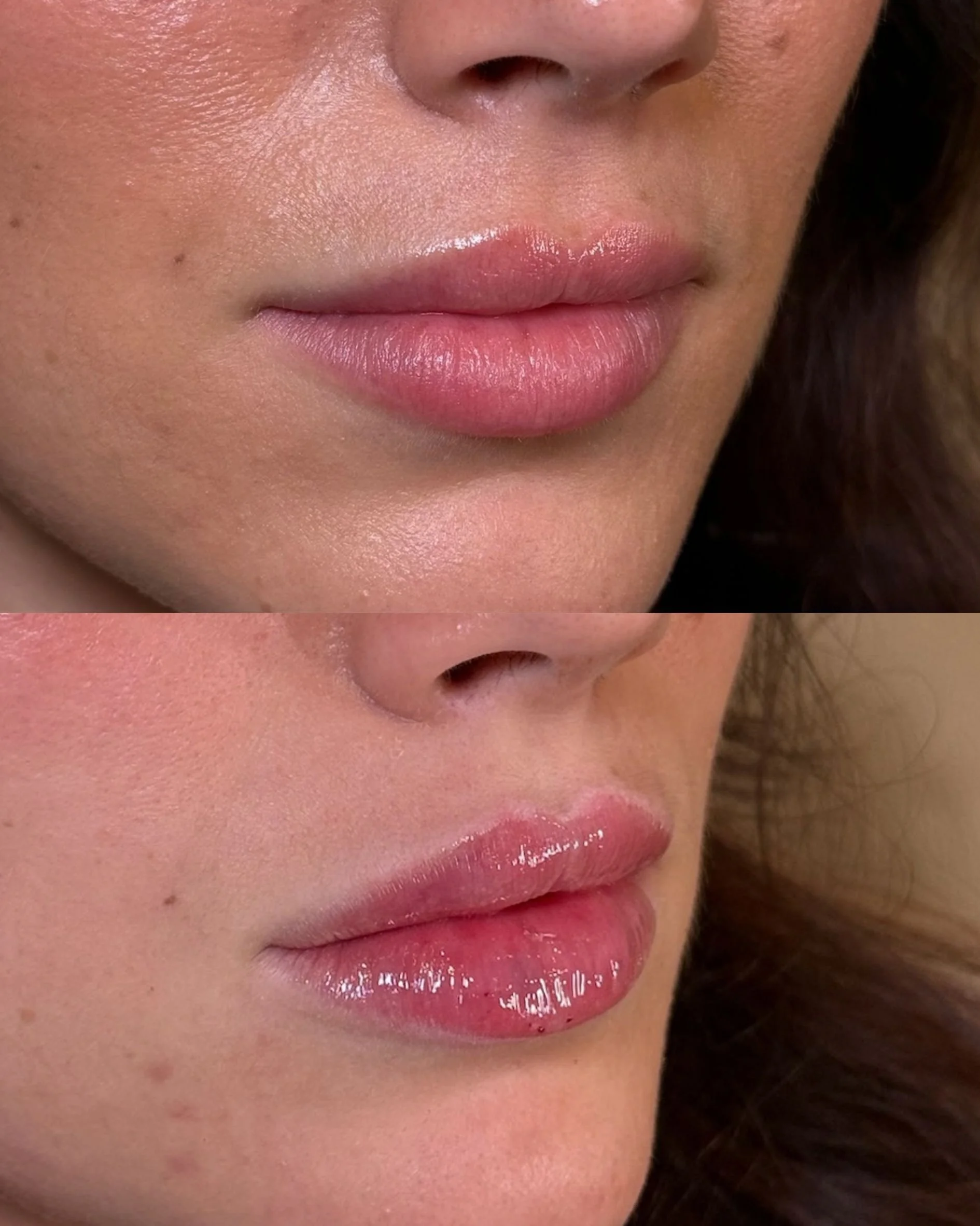 LIP FILLER.jpg