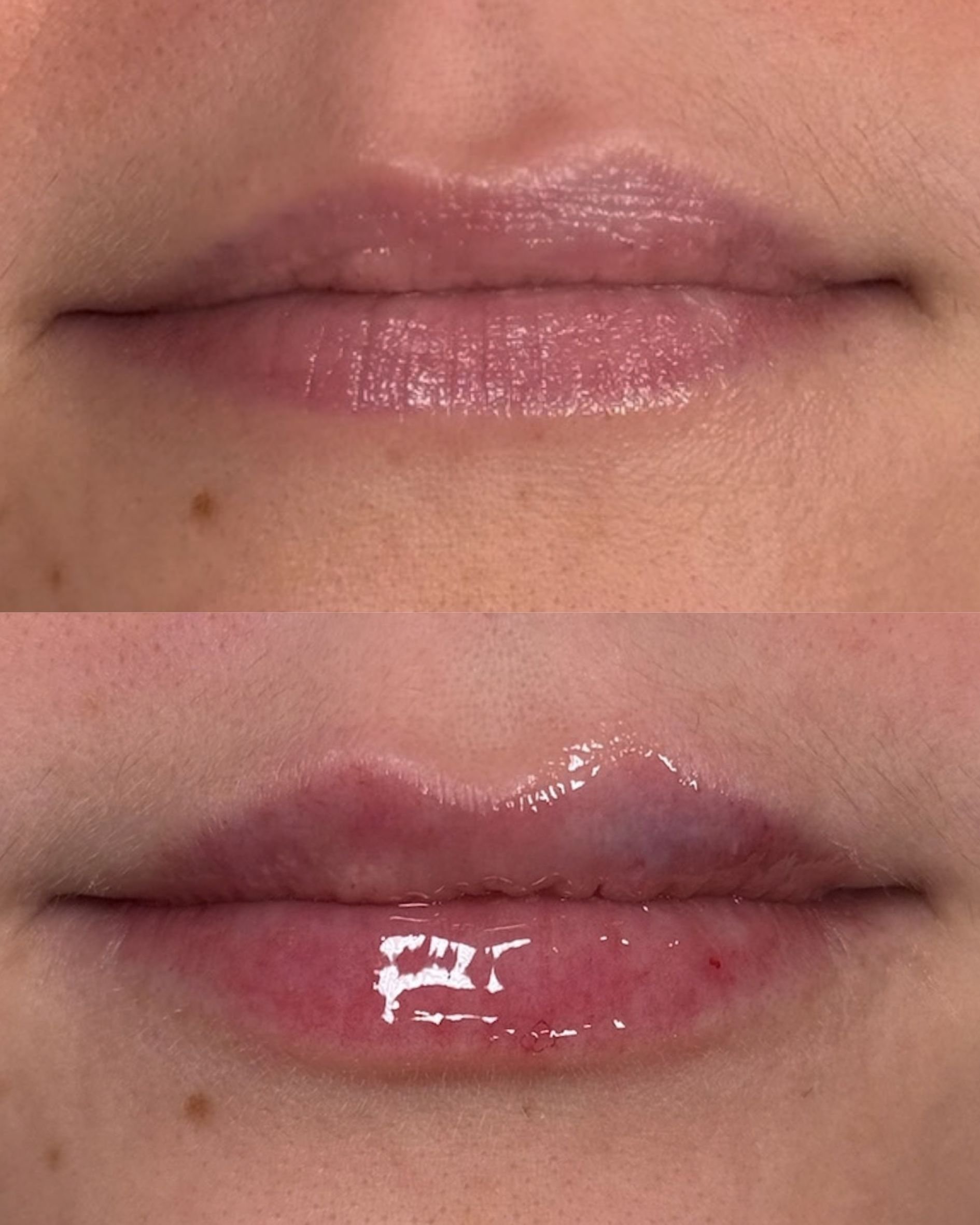 LIP FILLER (4).jpg
