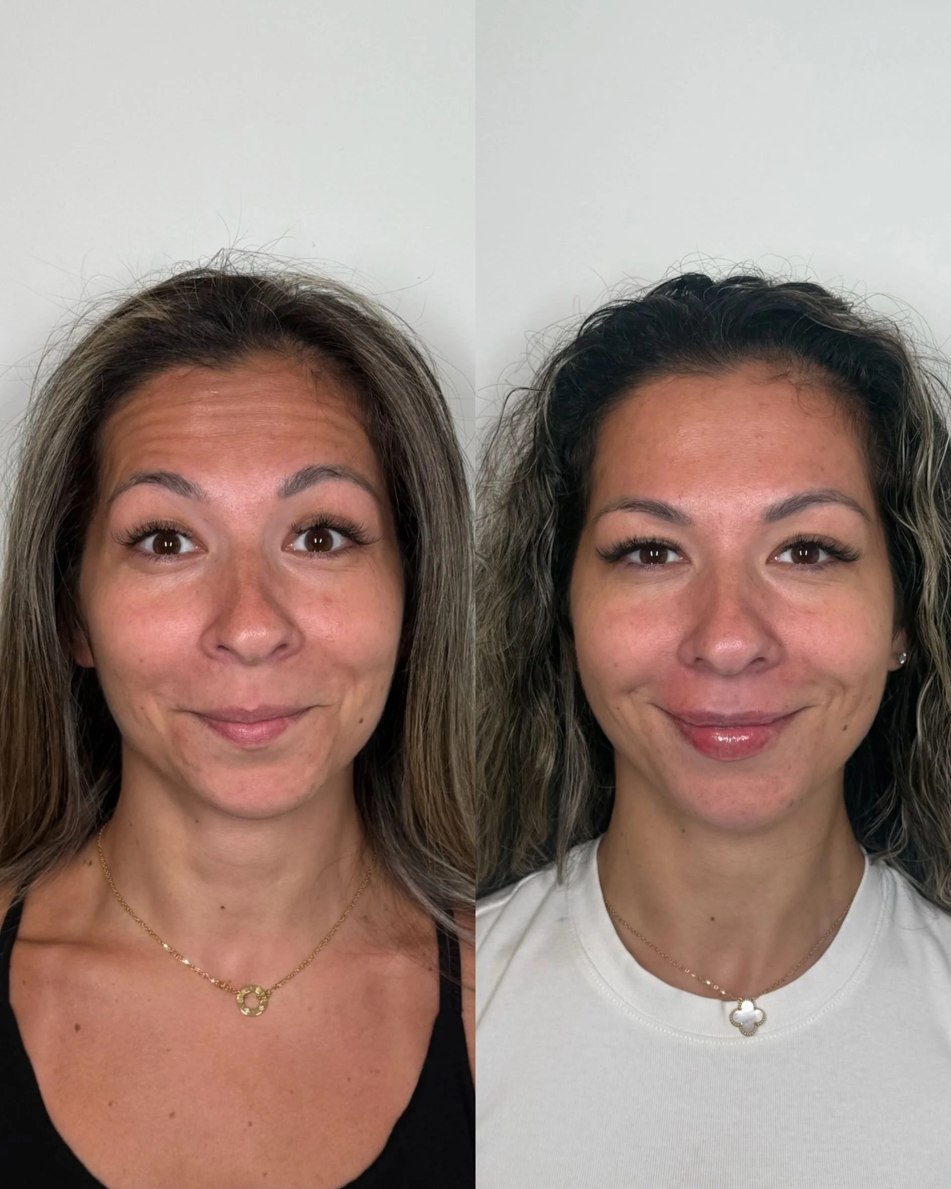 BOTOX (6).jpg