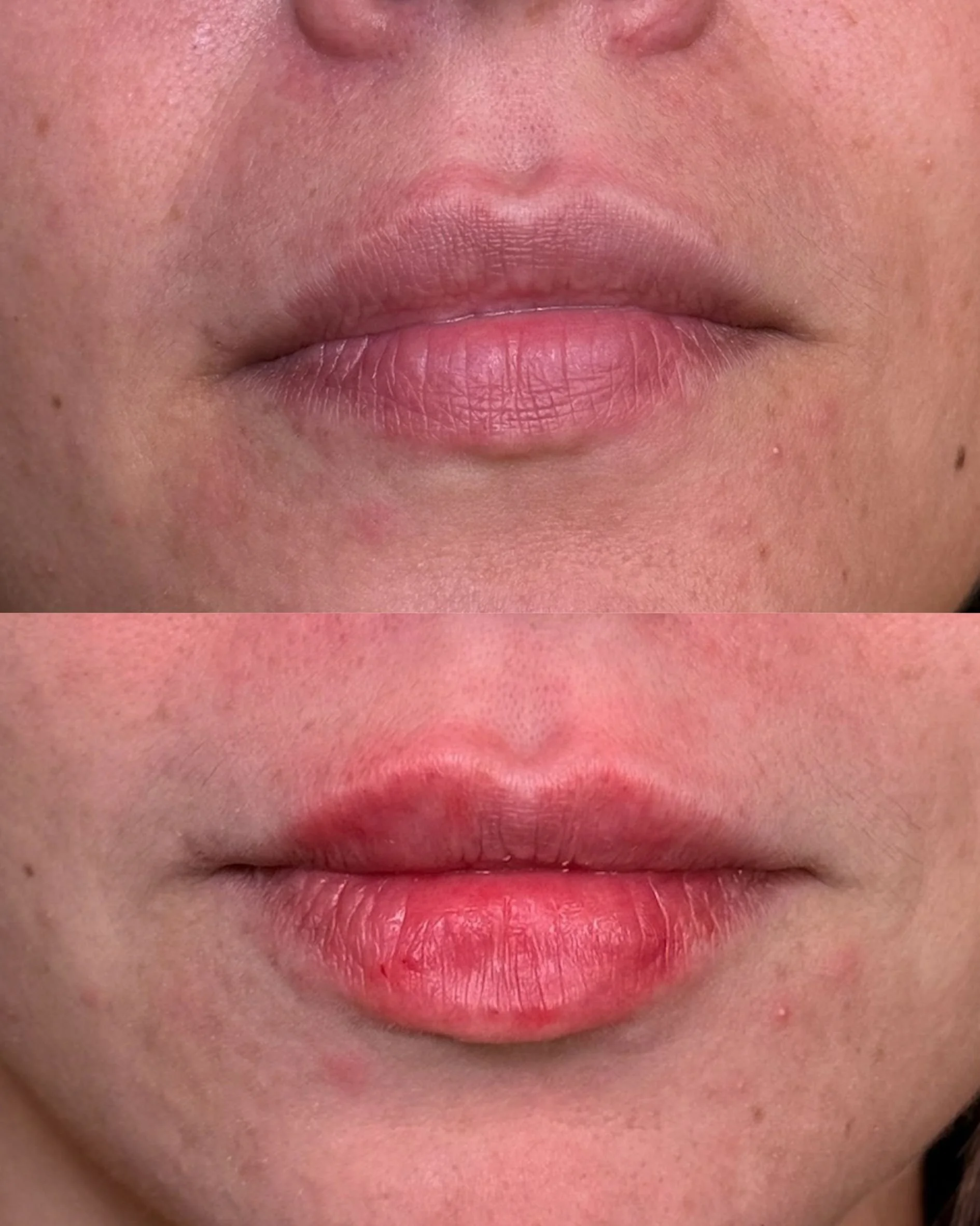 LIP FILLER (3).jpg