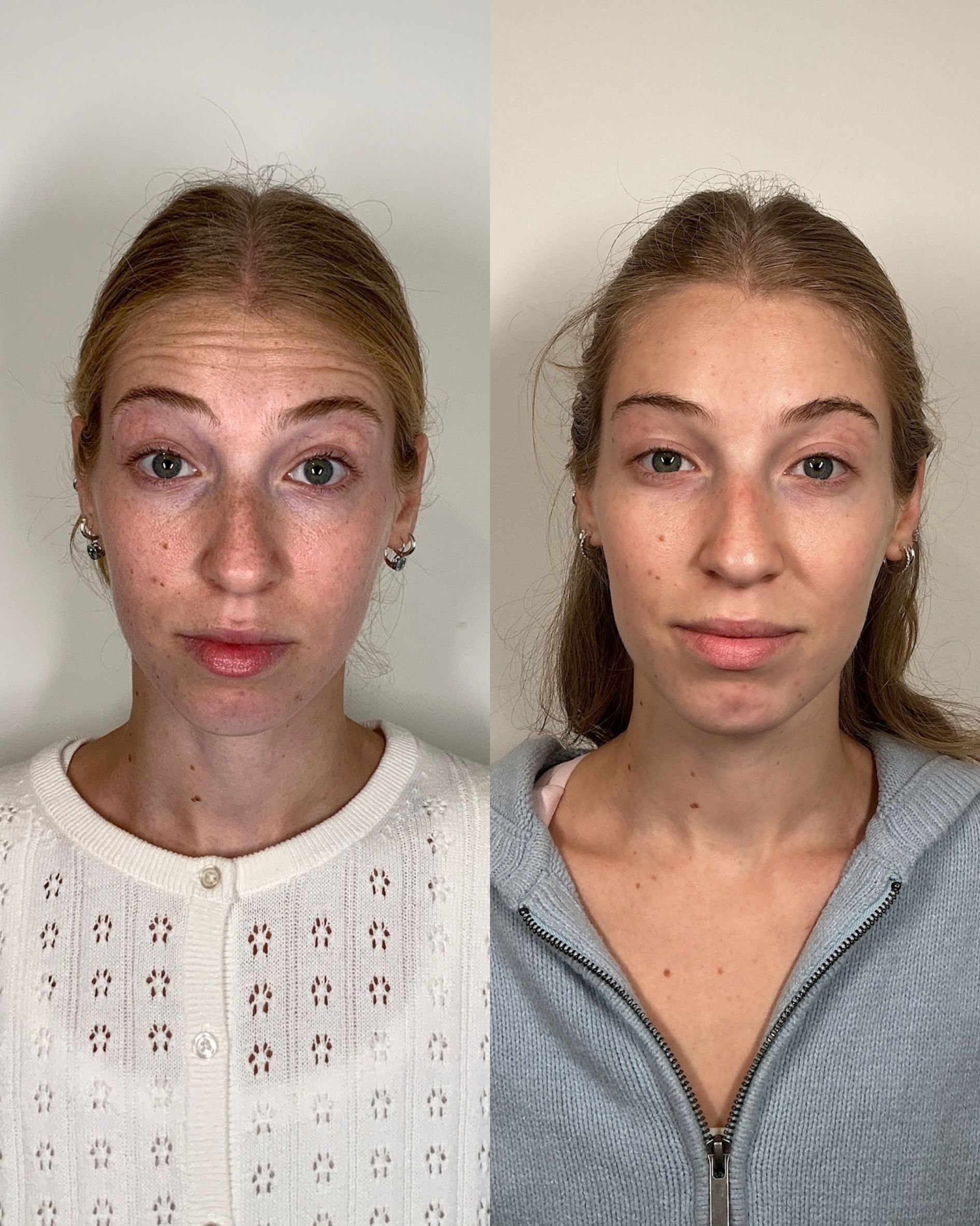 BOTOX.jpg
