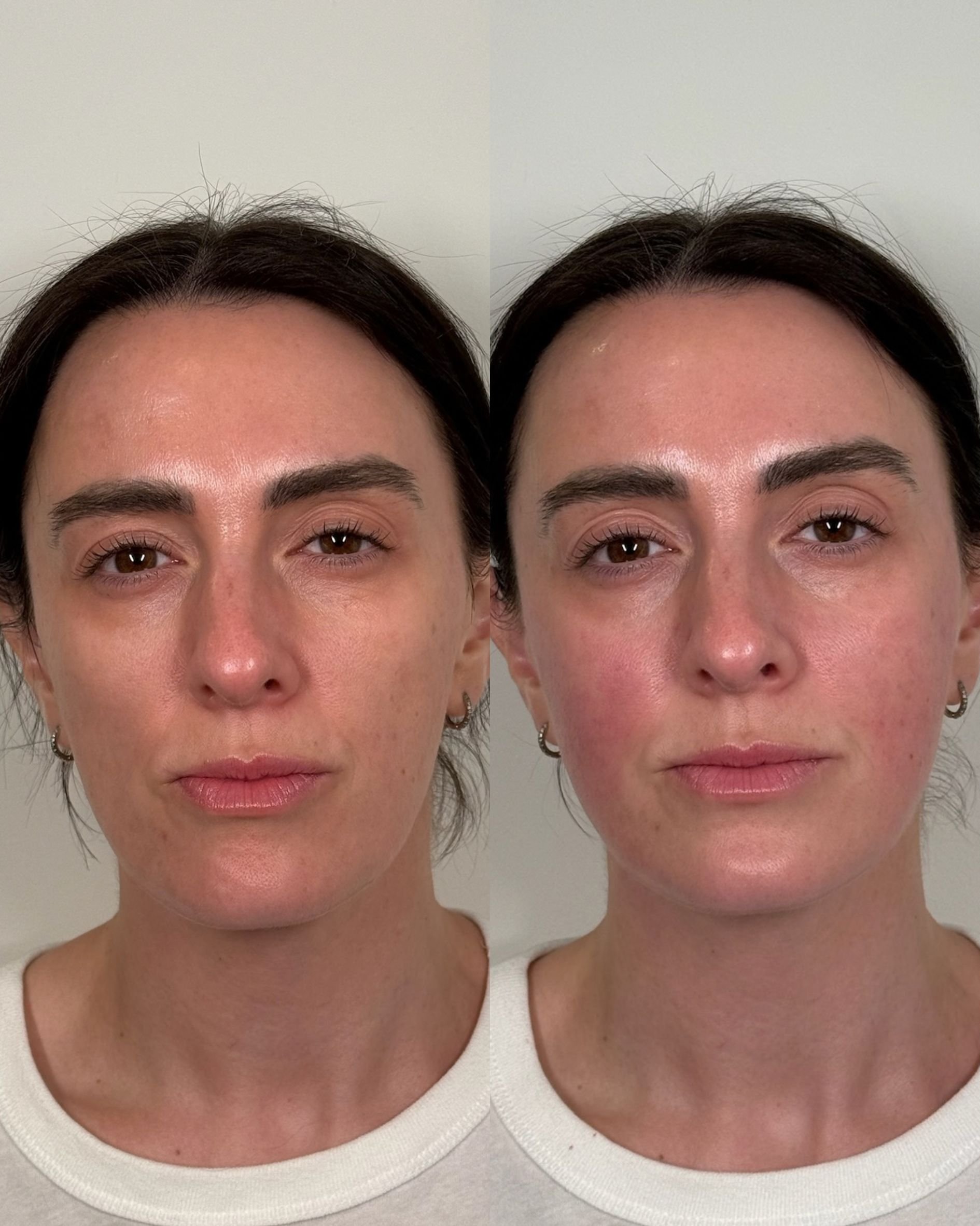 SCULPTRA (3).jpg